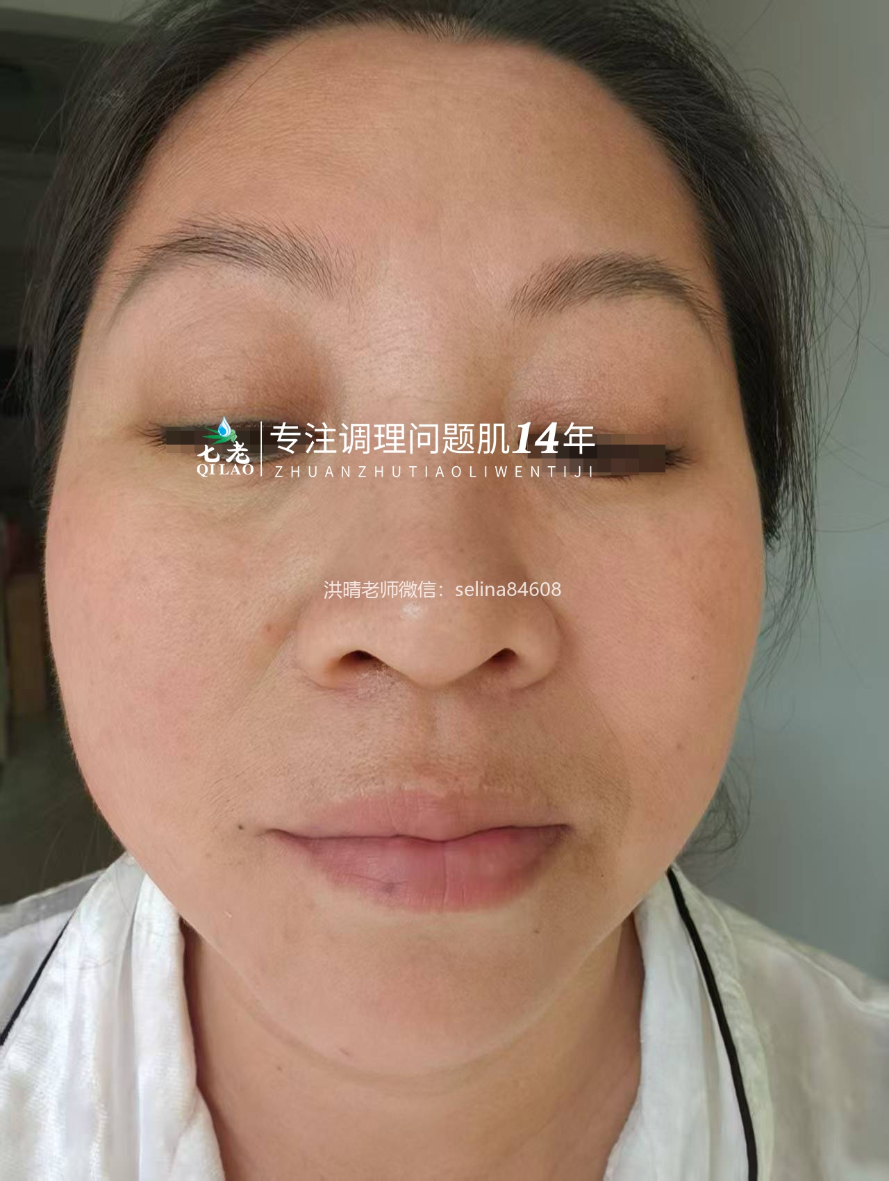 七老过敏性皮炎修护反馈