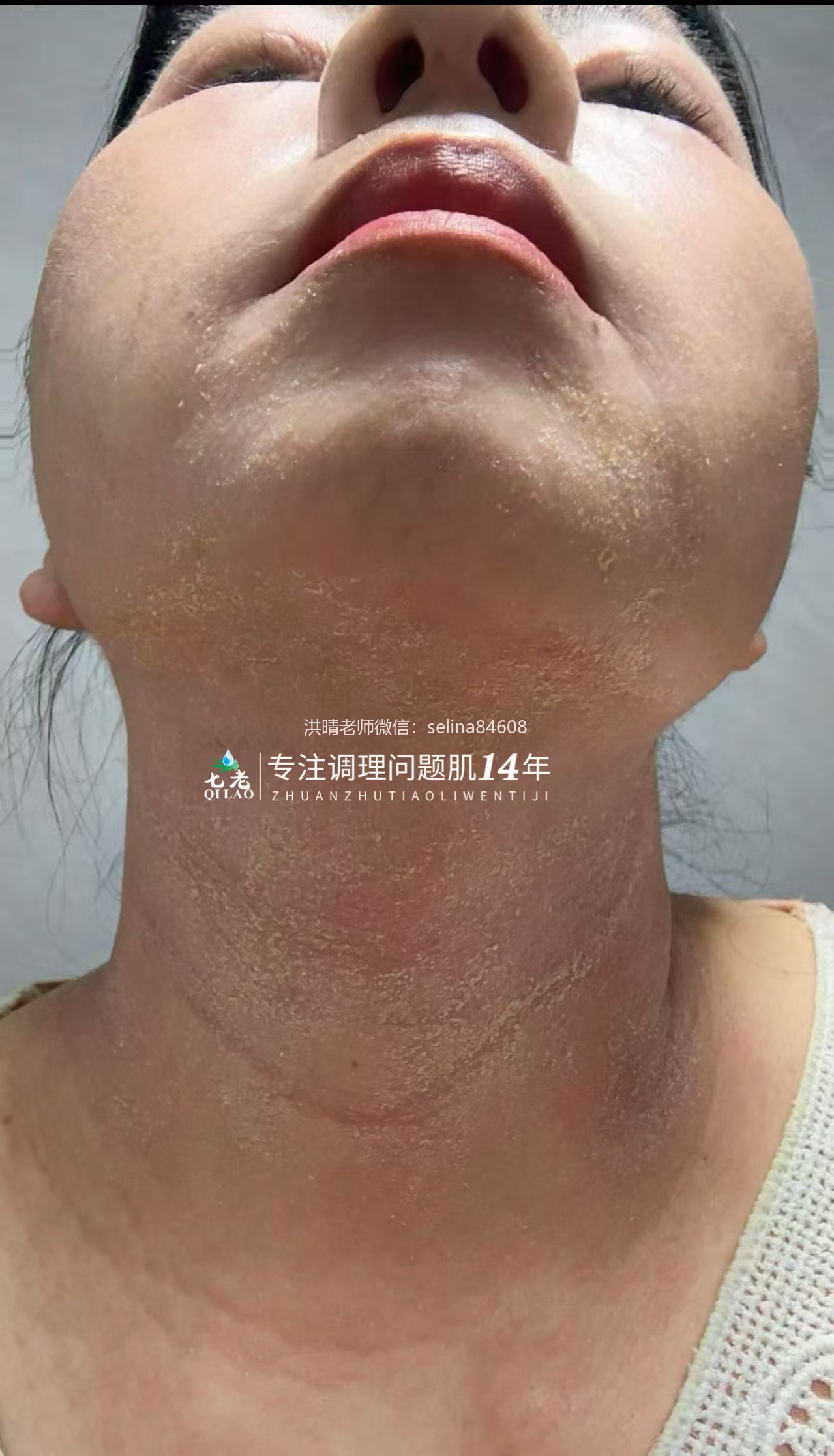 激素脸修护过程中脱皮怎么办？