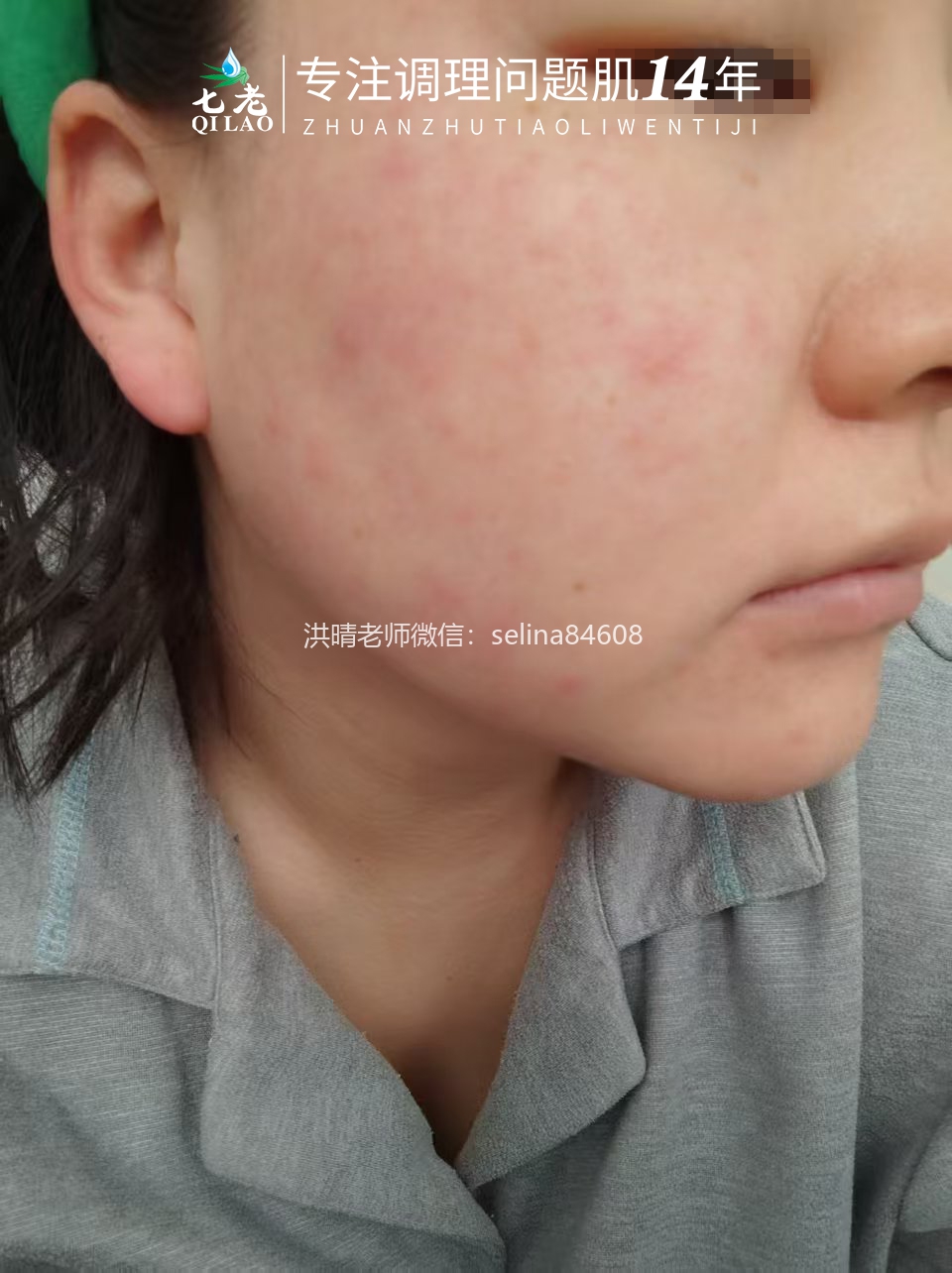 七老激素脸红烫痒疹子疙瘩修护案例