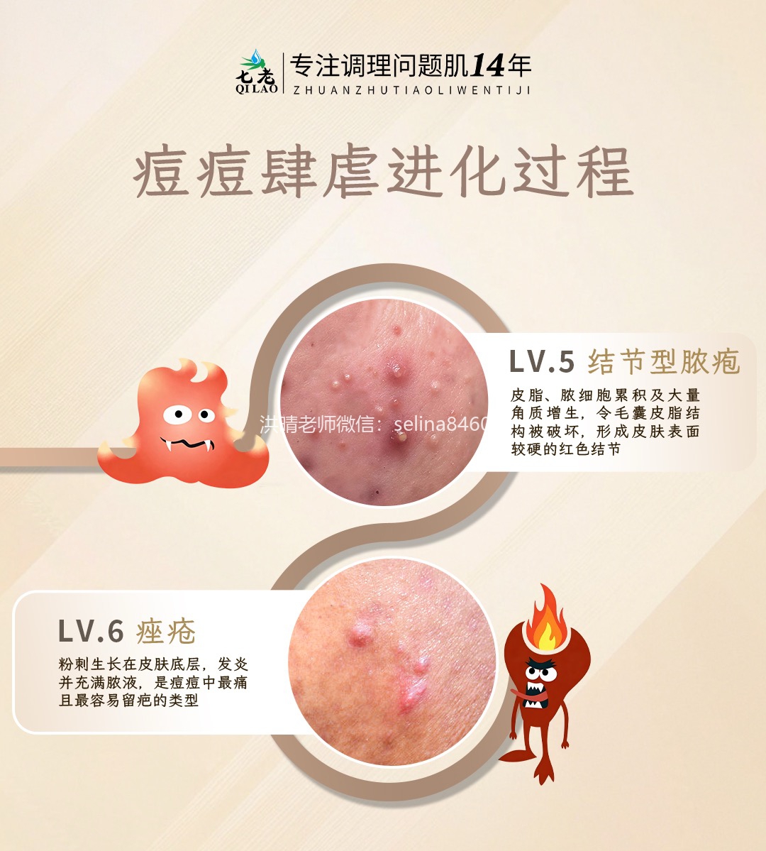 七老洪晴专业知识科普→痘痘痤疮严重程度怎么区分？