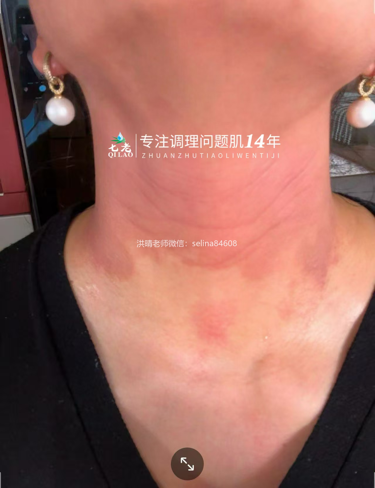 激素脸修护过程中脱皮怎么办？