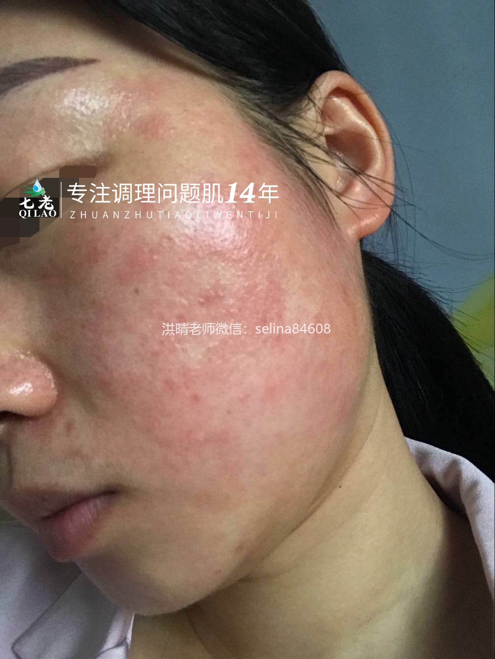 七老干红烫肿痒疹子疙瘩修护案例