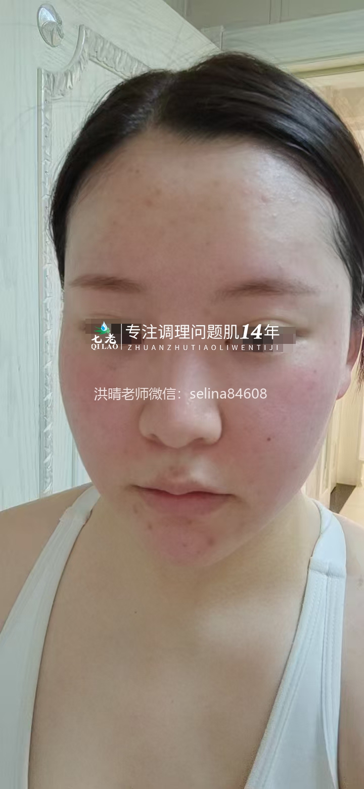 七老激素脸红烫痒疹子疙瘩修护案例