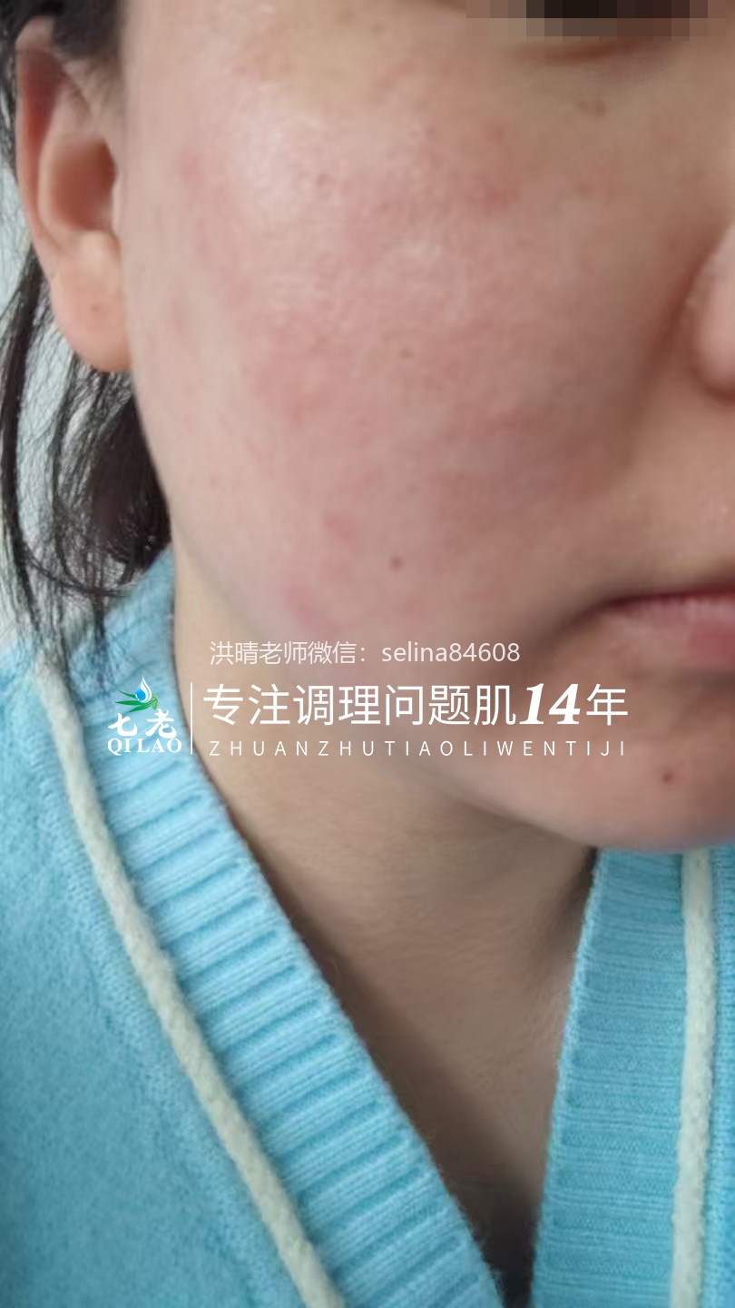 七老激素脸红烫痒疹子疙瘩修护案例