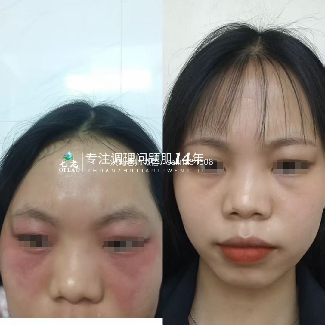 七老眼周反复过敏红肿痒修护案例