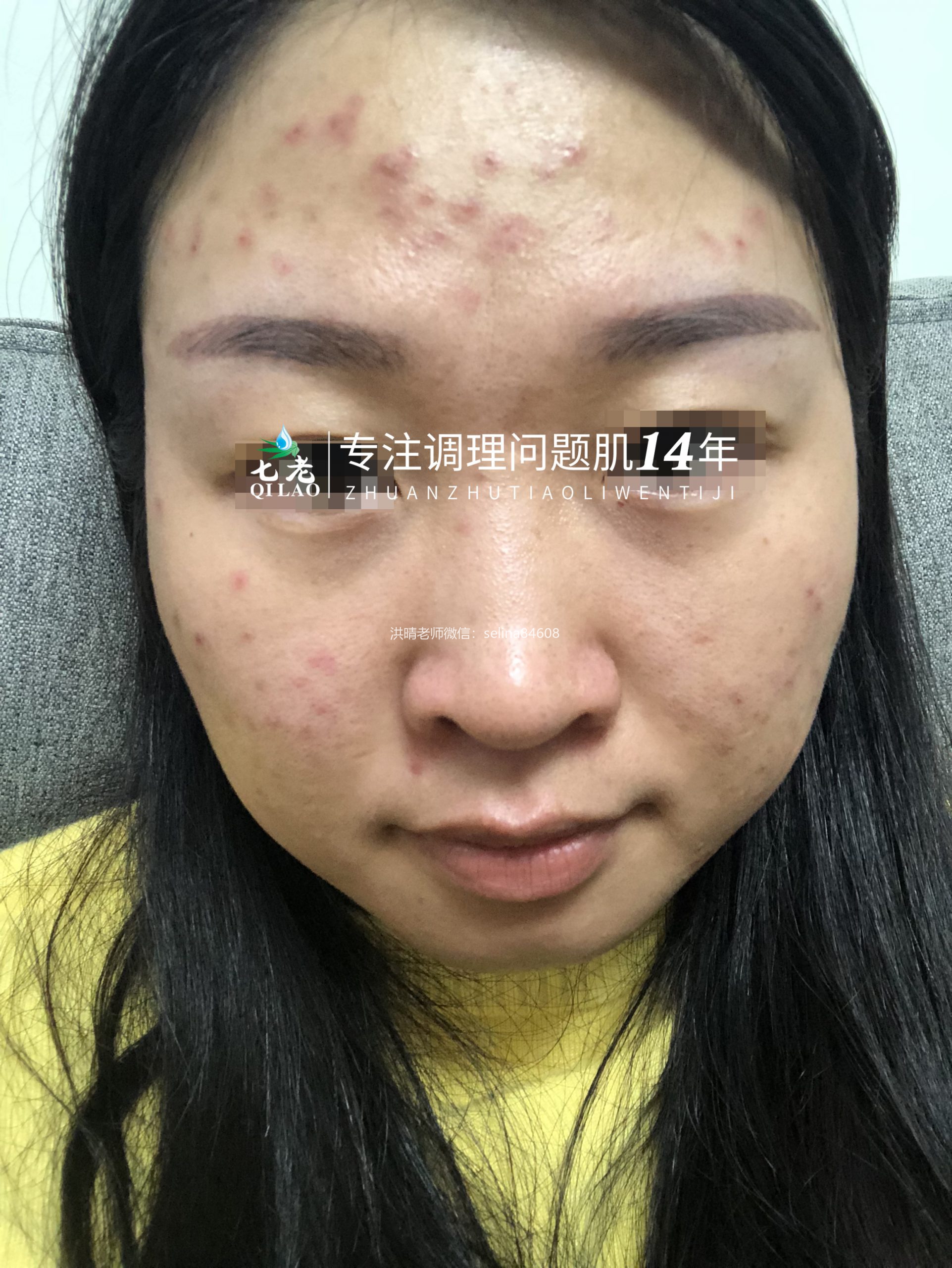 七老干红烫肿痒疹子疙瘩修护案例