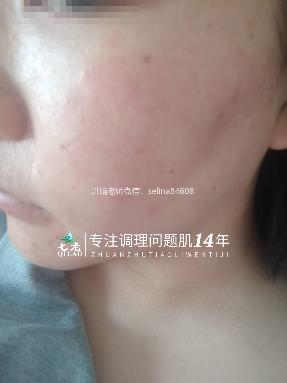 七老激素脸红烫痒疹子疙瘩修护案例