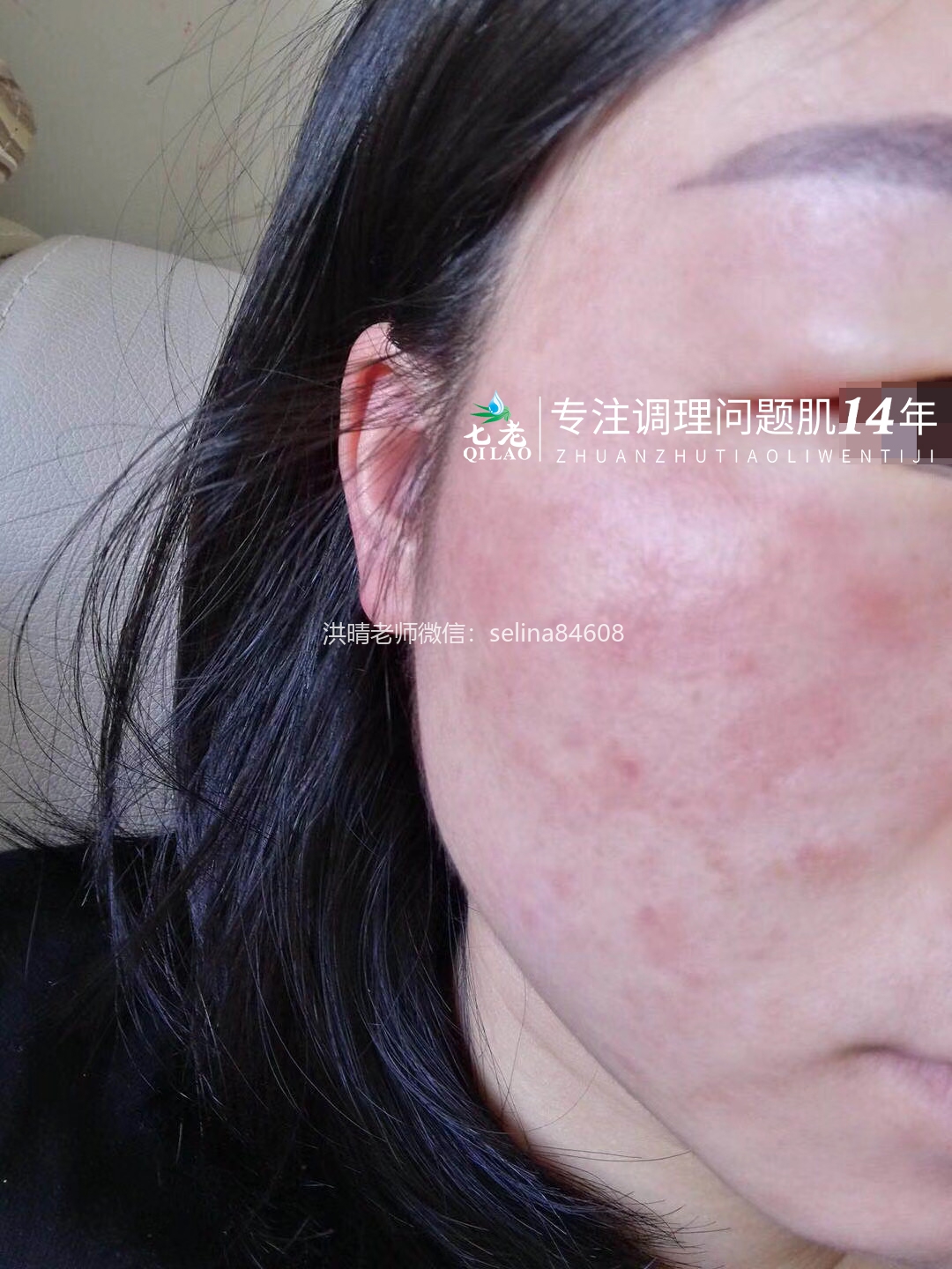 七老干红烫肿痒疹子疙瘩修护案例