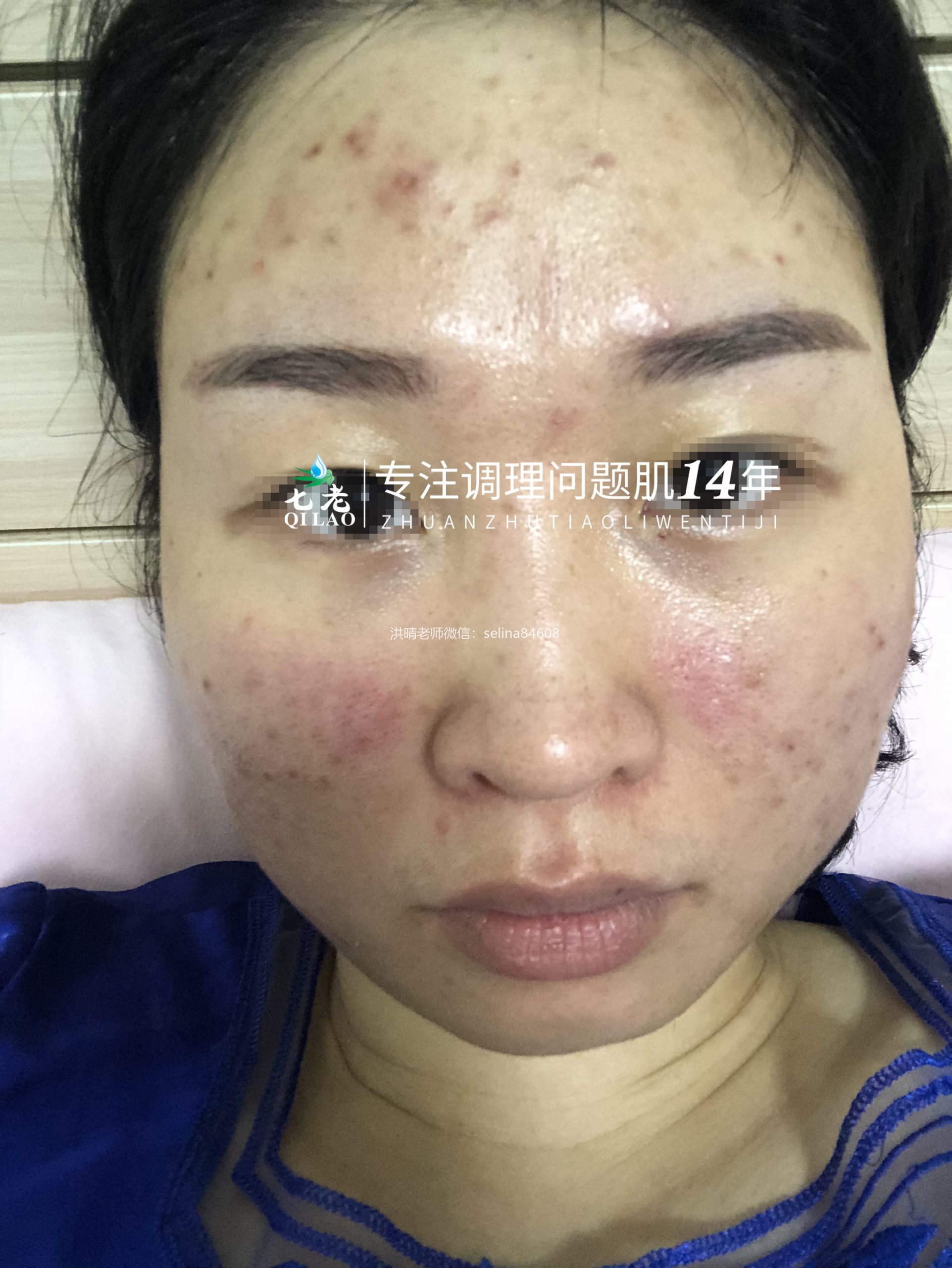 七老干红烫肿痒疹子疙瘩修护案例