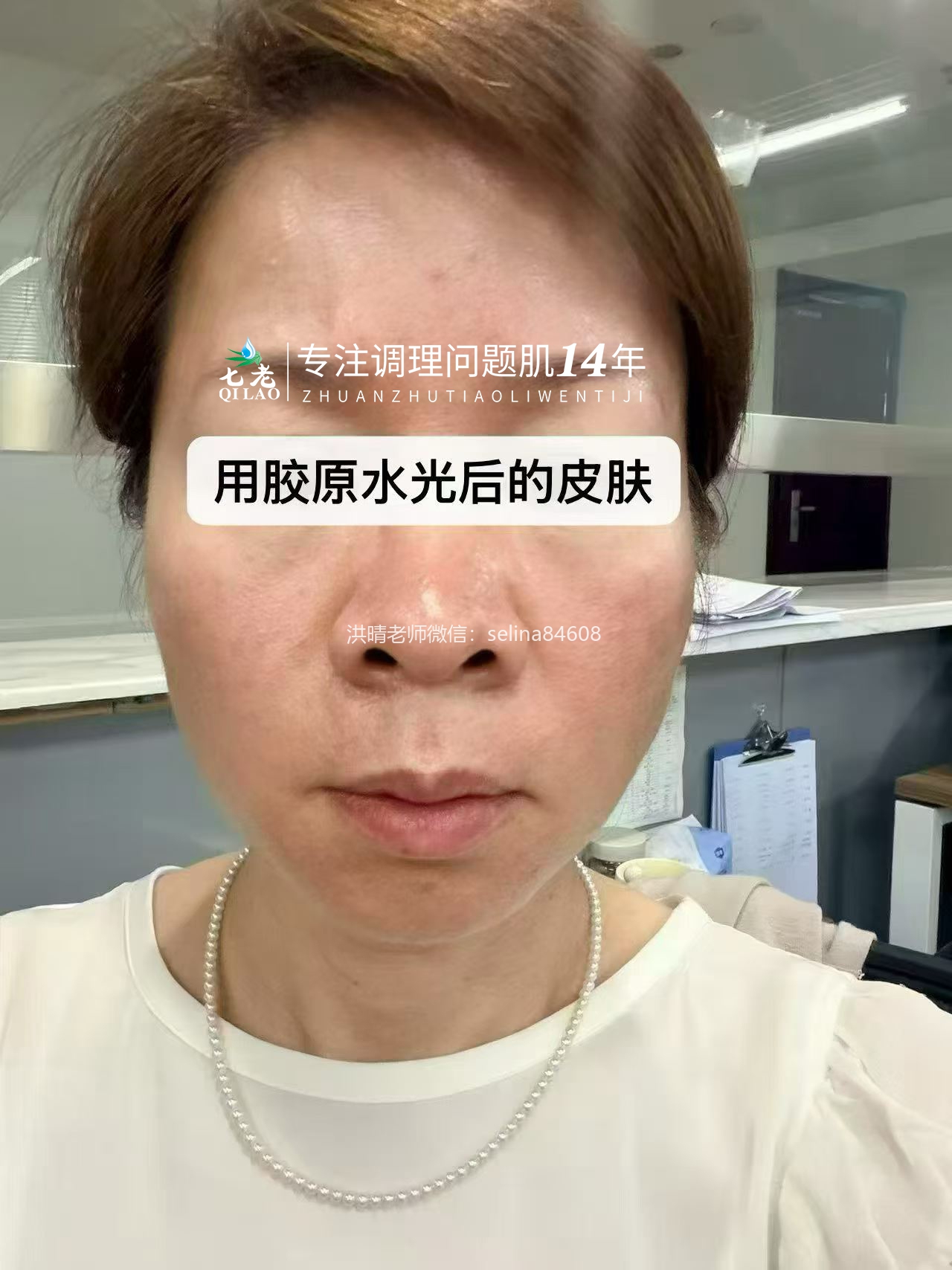 七老激素脸➕玫瑰痤疮➕脂皮修护案例