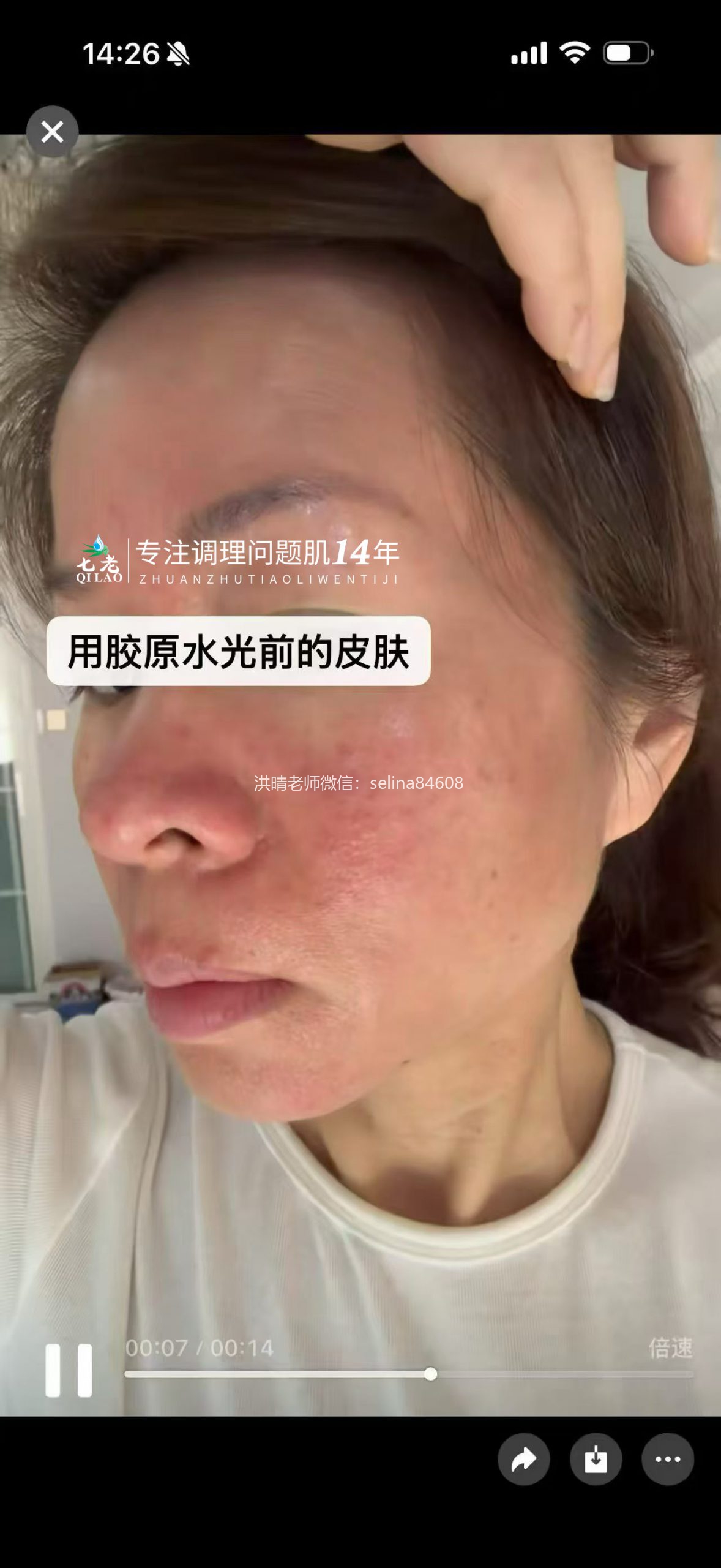七老激素脸➕玫瑰痤疮➕脂皮修护案例