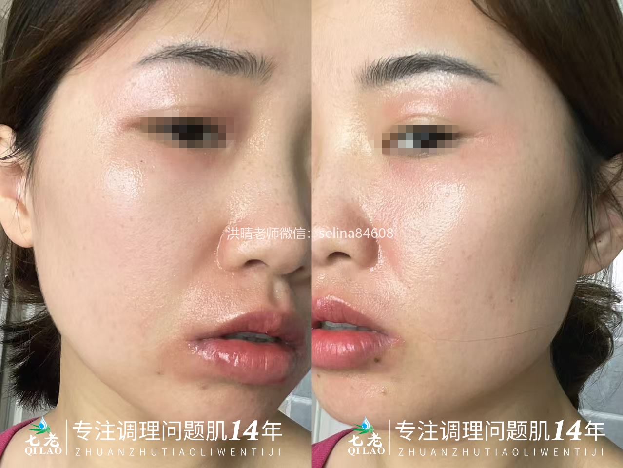 七老痘痘肌案例