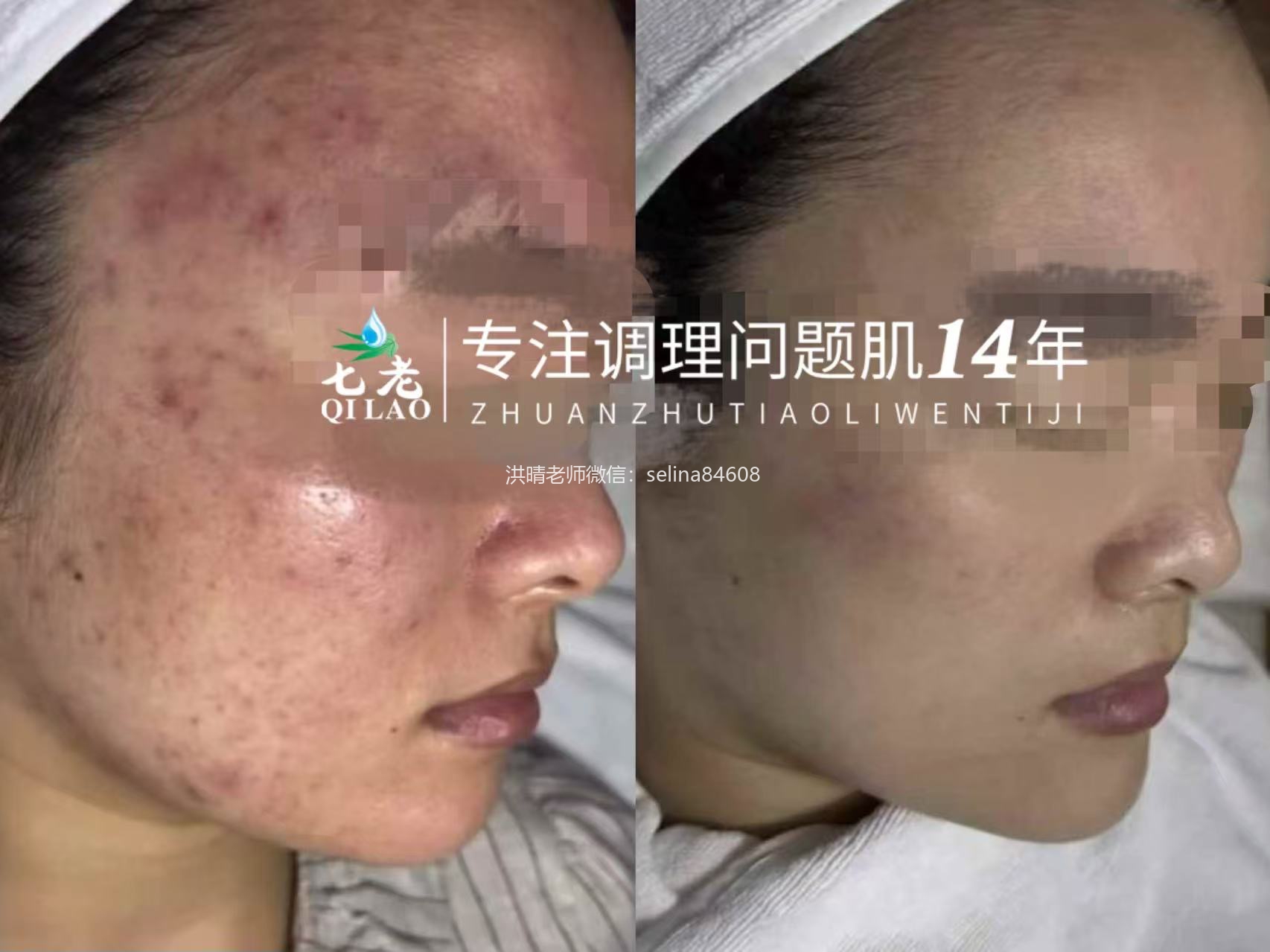 七老激素脸修护半年的前后对比