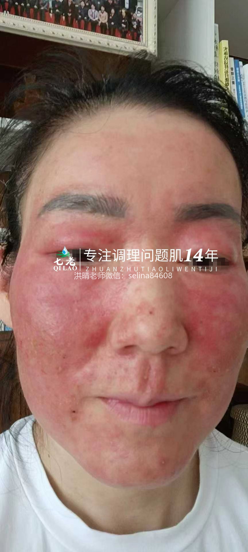 七老严重激素脸红肿烫痒疹子渗液结痂修护案例