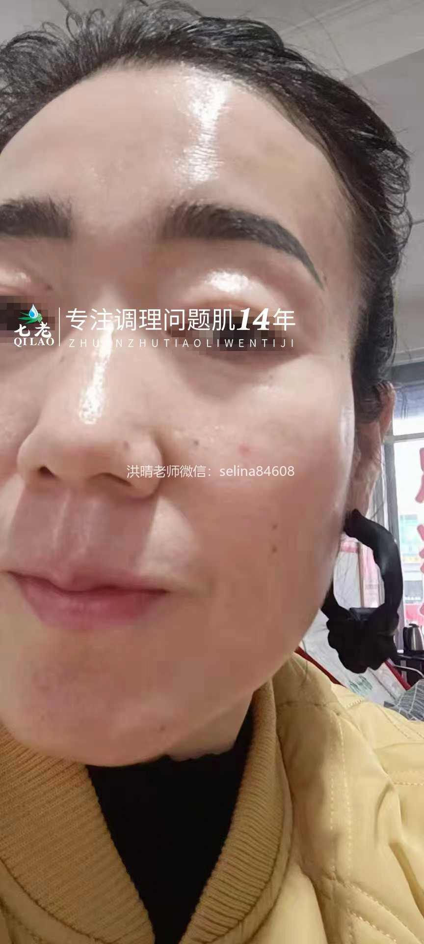 七老严重激素脸红肿烫痒疹子渗液结痂修护案例