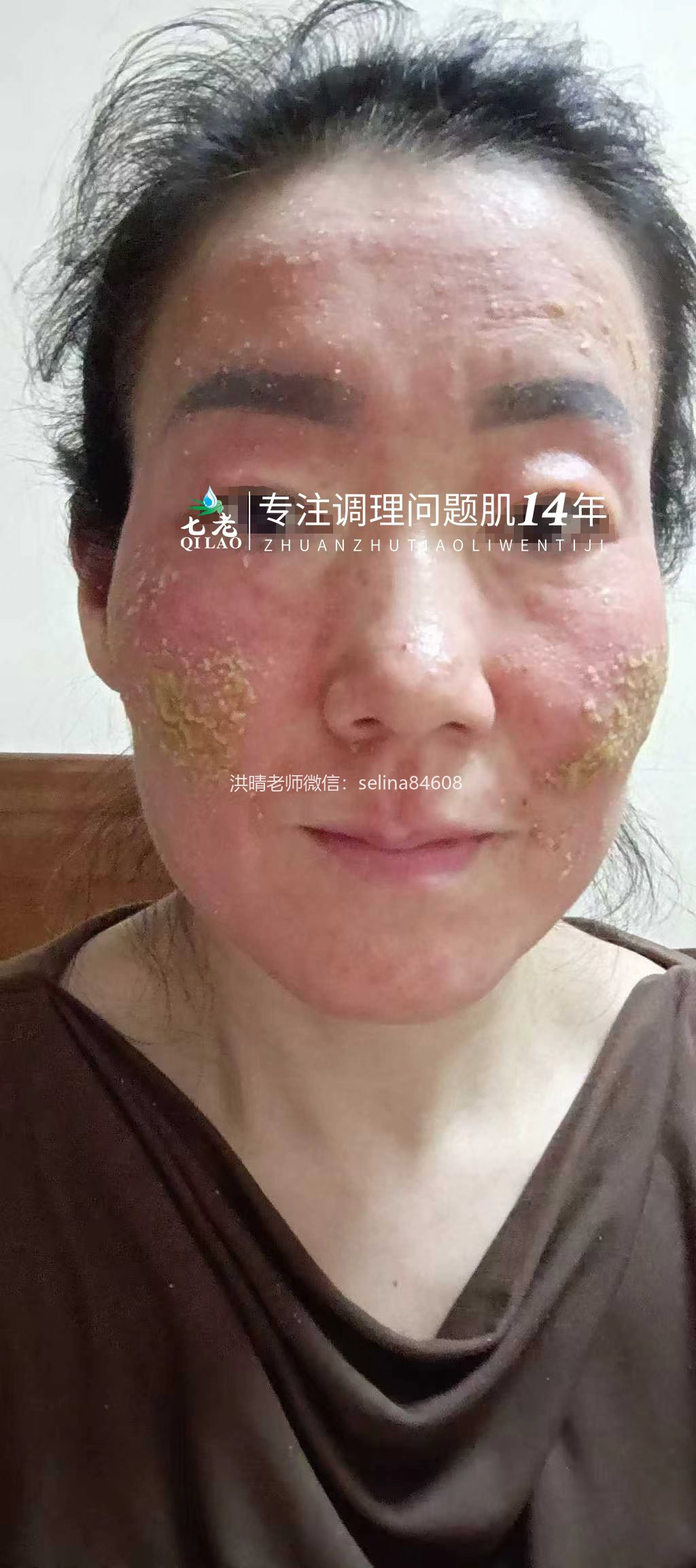 七老严重激素脸红肿烫痒疹子渗液结痂修护案例