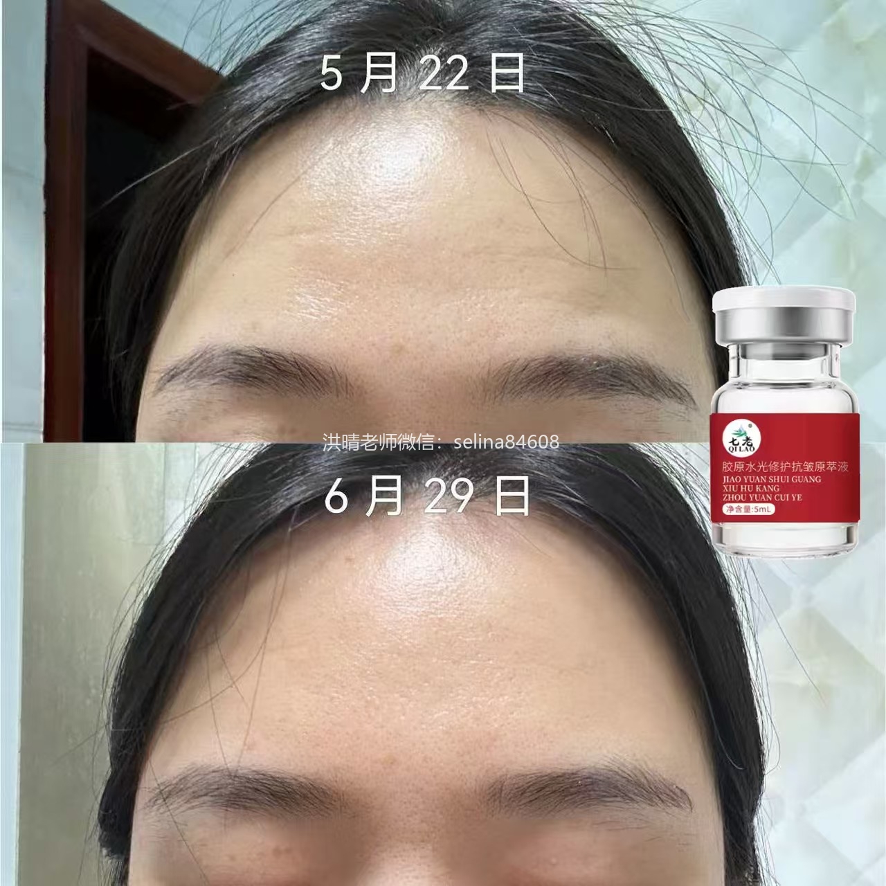 七老胶原水光抬头纹对比效果，激素脸激素痘修护过来的，谁能看出她曾经那么严重的痘肌烂脸