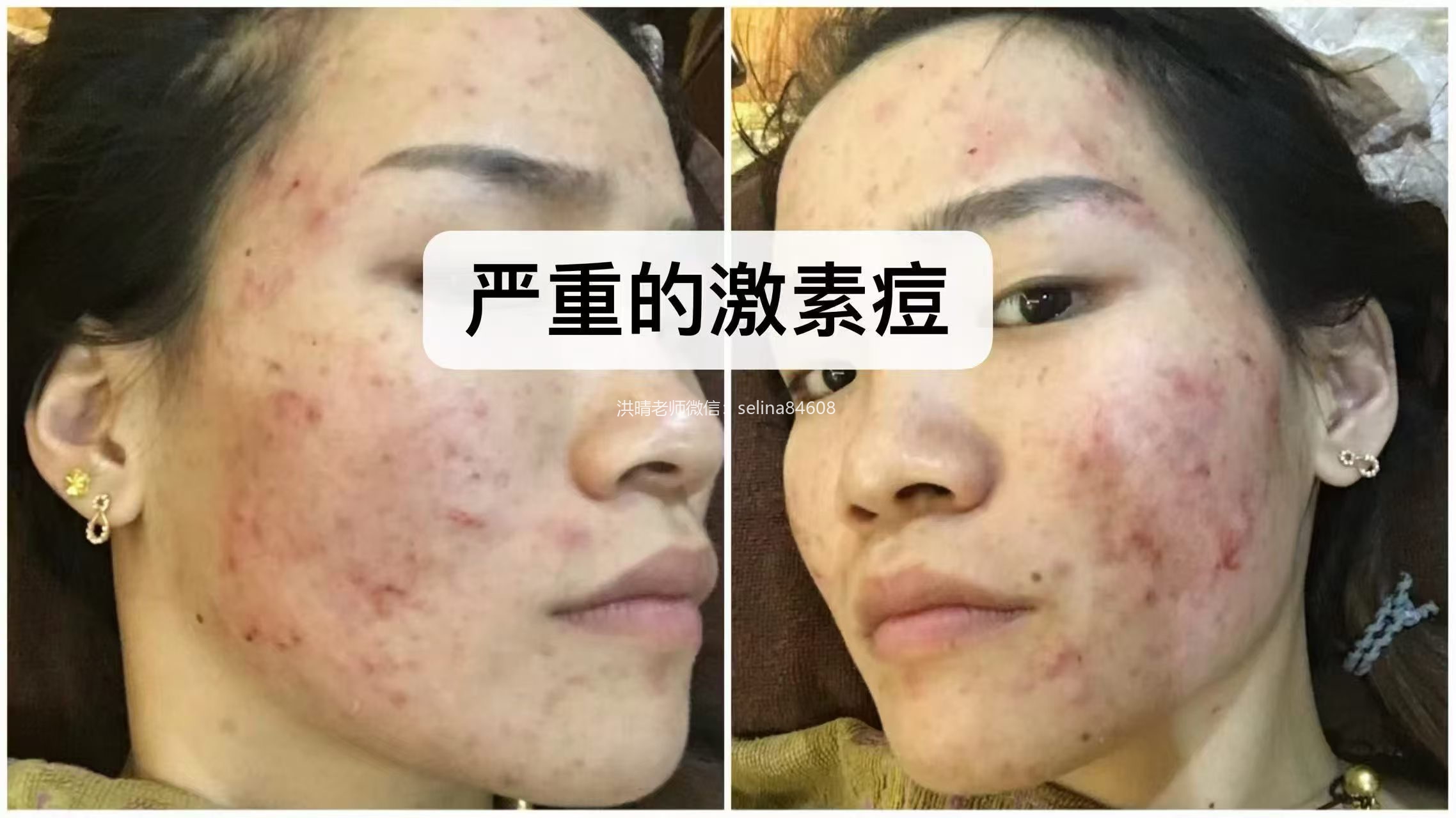 七老胶原水光抬头纹对比效果，激素脸激素痘修护过来的，谁能看出她曾经那么严重的痘肌烂脸
