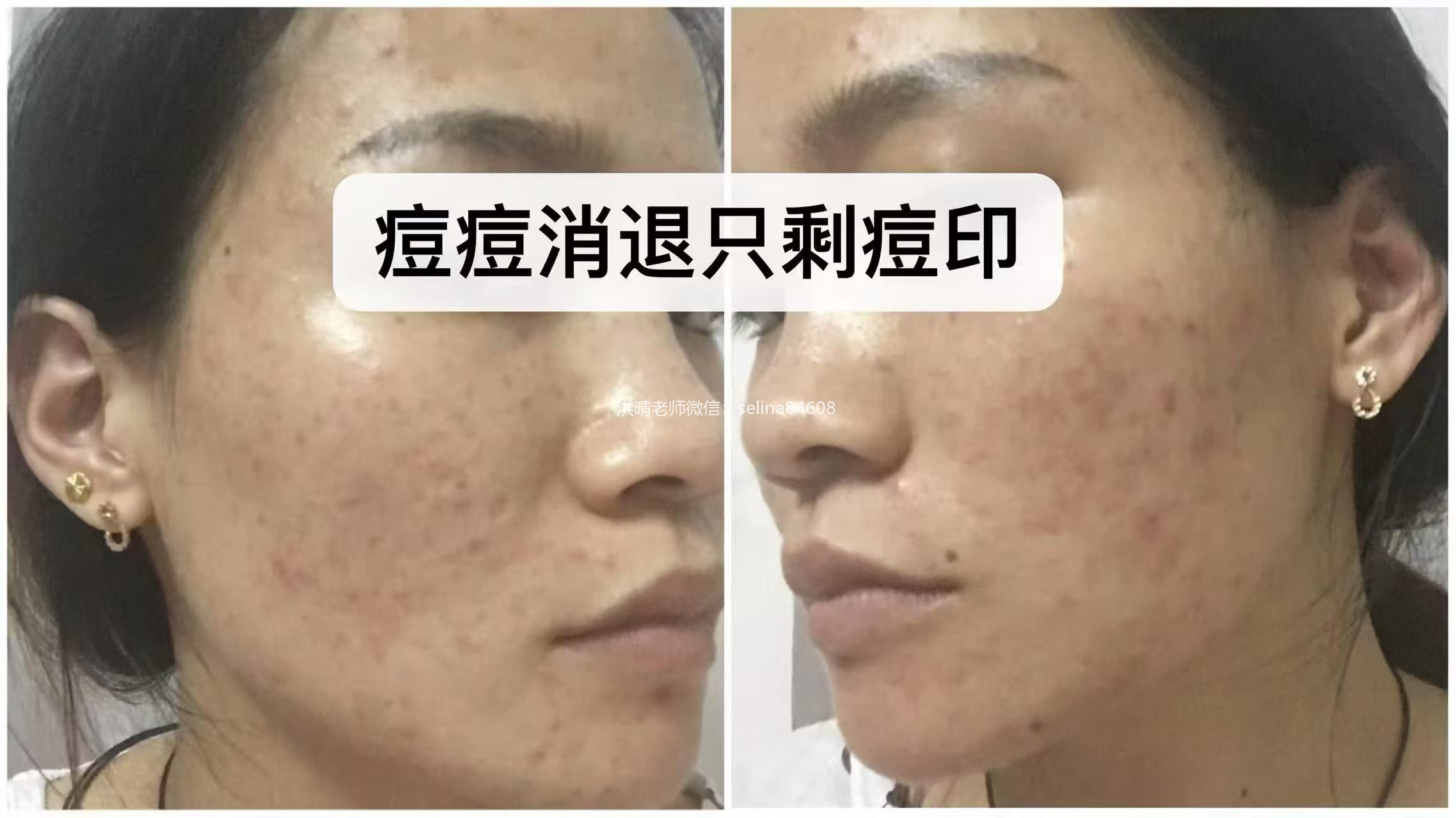 七老胶原水光抬头纹对比效果，激素脸激素痘修护过来的，谁能看出她曾经那么严重的痘肌烂脸
