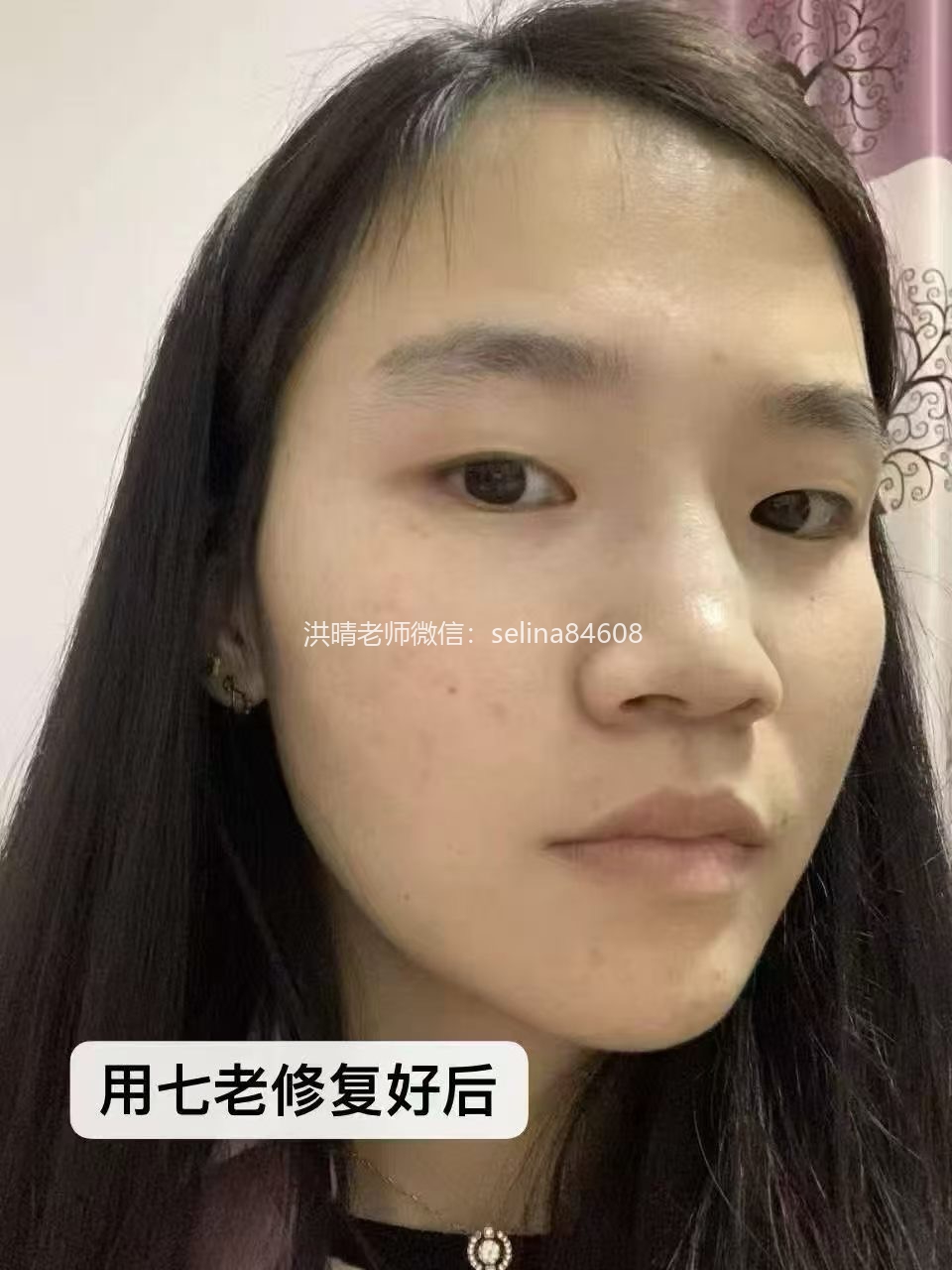 七老胶原水光抬头纹对比效果，激素脸激素痘修护过来的，谁能看出她曾经那么严重的痘肌烂脸