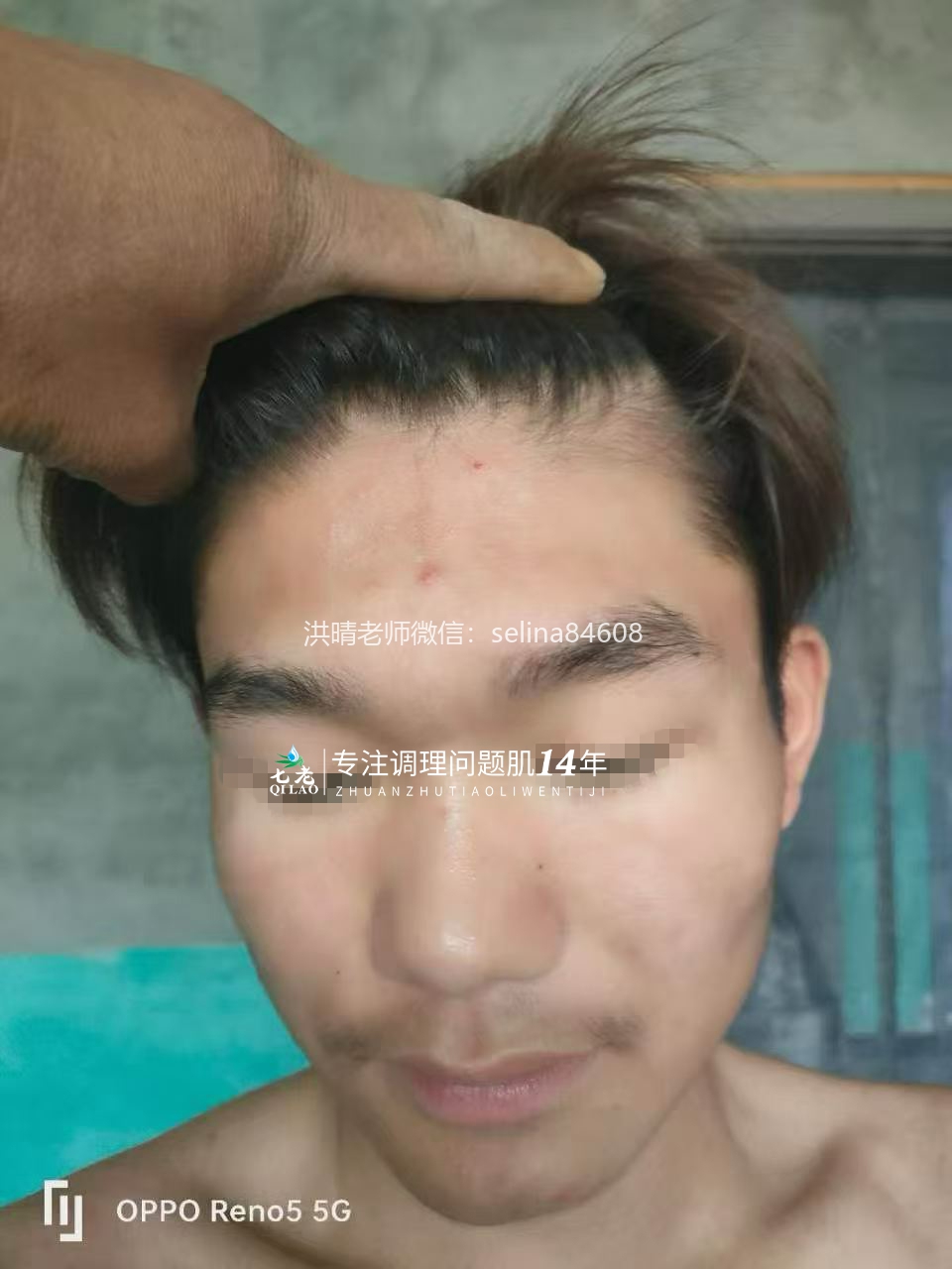 七老激素脸玫瑰痤疮脂溢性皮炎修护案例