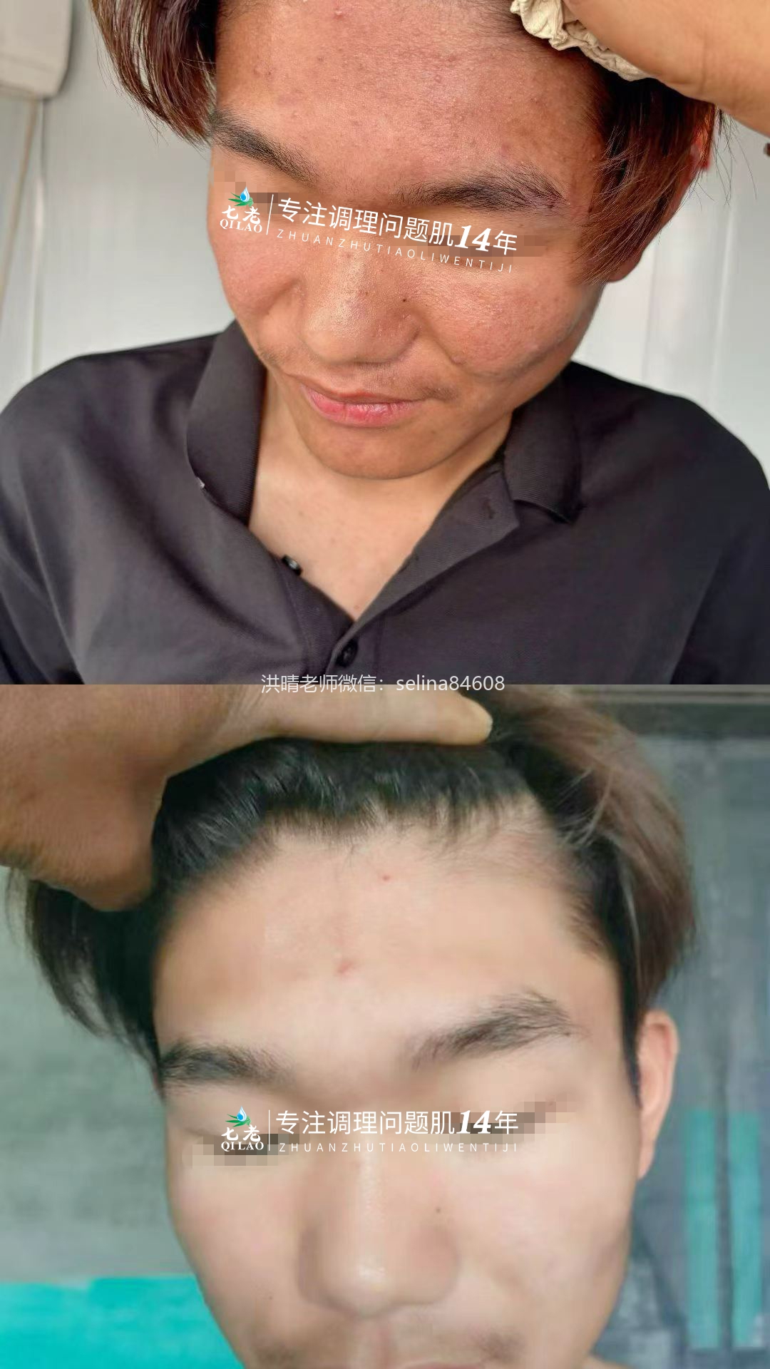 七老激素脸玫瑰痤疮脂溢性皮炎修护案例