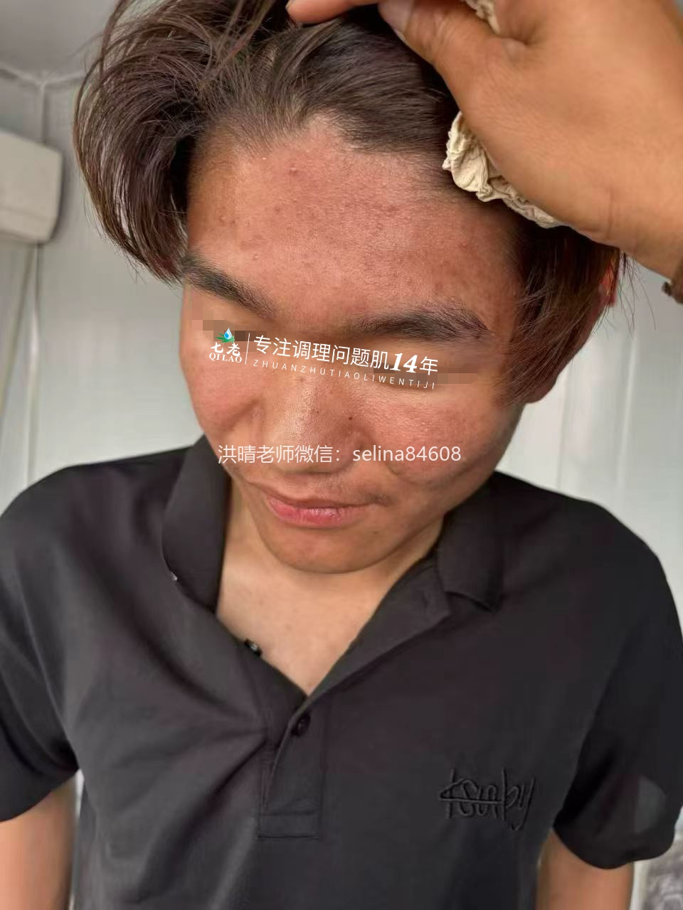 七老激素脸玫瑰痤疮脂溢性皮炎修护案例