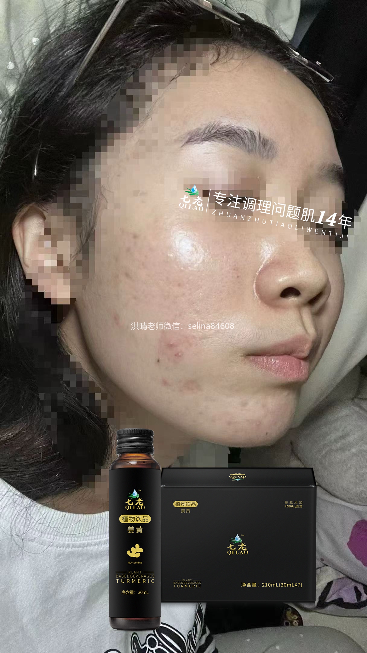 七老激素脸激素痘修护案例，外用修护结合内调才是根本