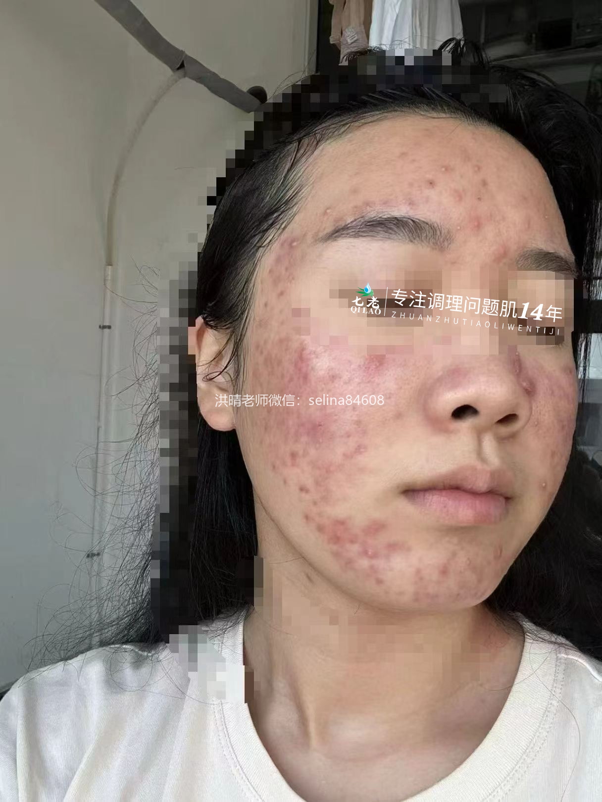 七老激素脸激素痘修护案例,外用修护结合内调才是根本