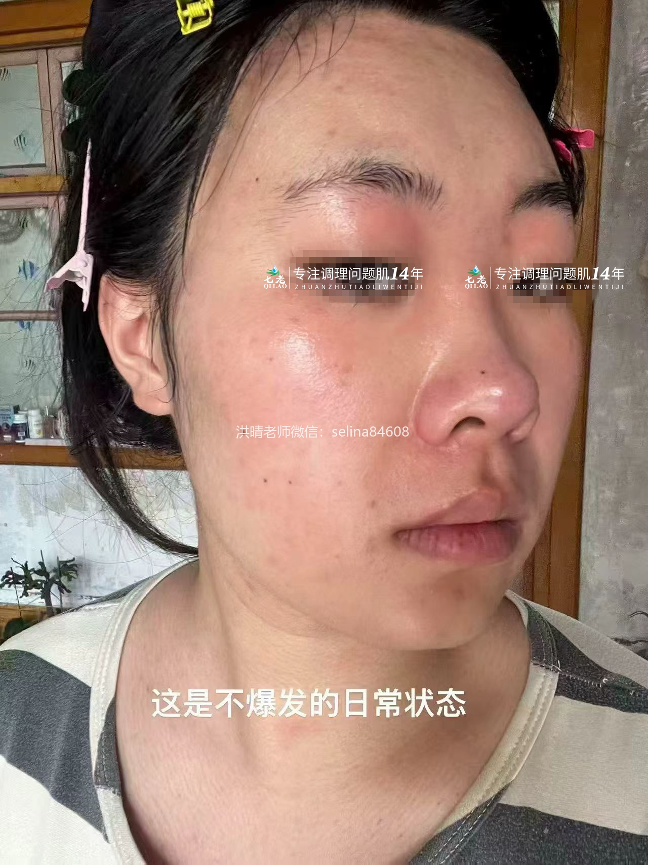 七老成片发红发烫大红脸修护案例