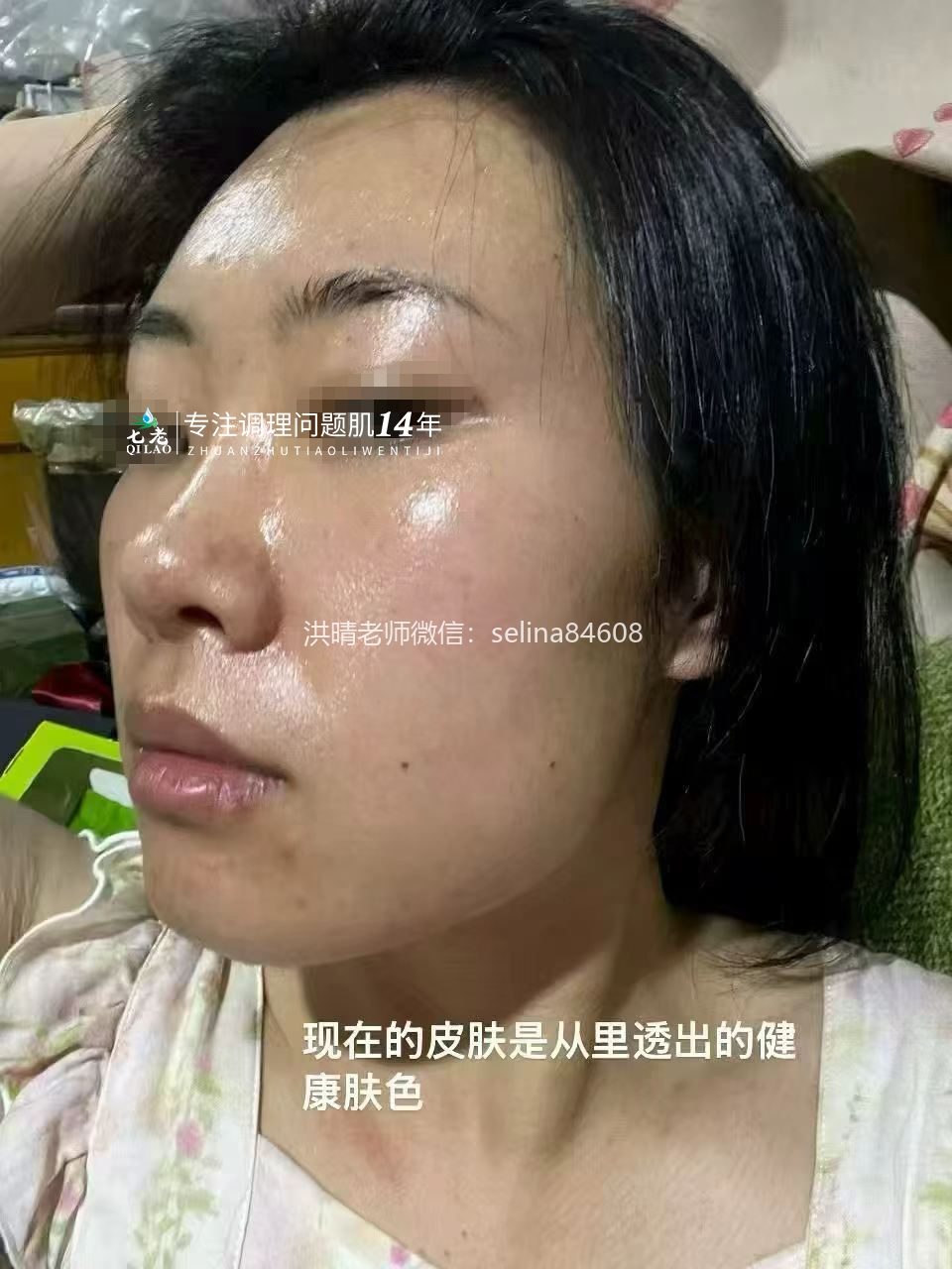 七老成片发红发烫大红脸修护案例