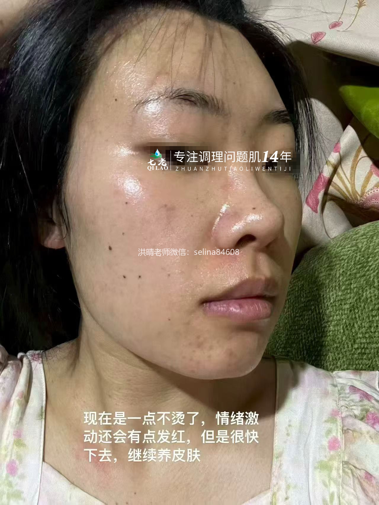 七老成片发红发烫大红脸修护案例