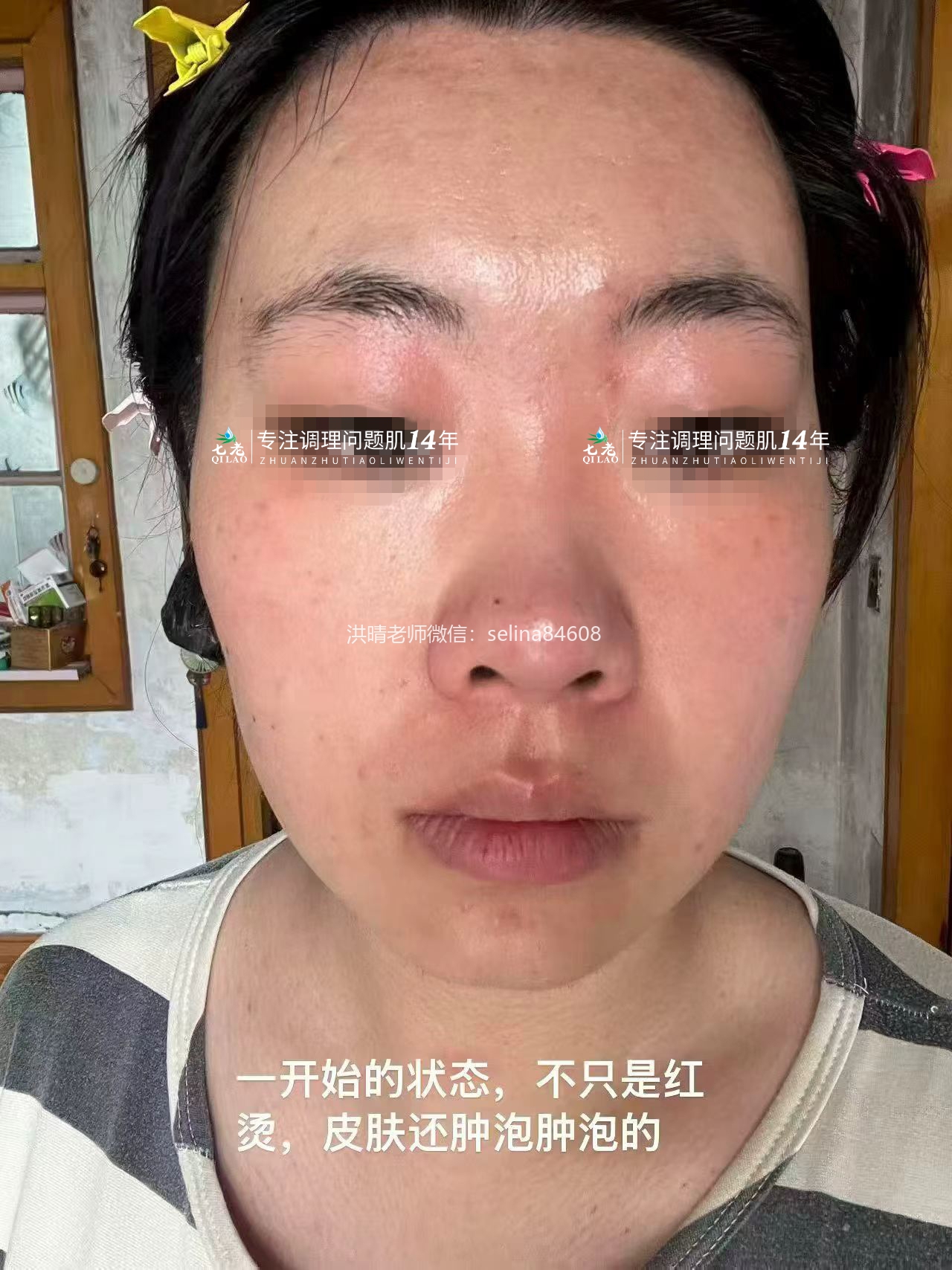 七老成片发红发烫大红脸修护案例