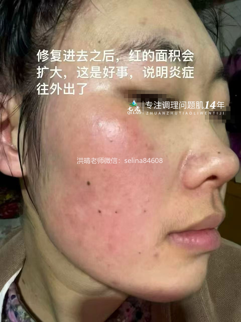 七老成片发红发烫大红脸修护案例