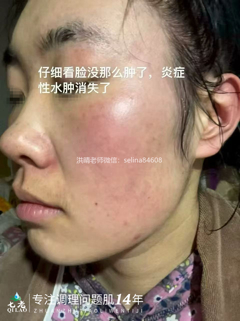 七老成片发红发烫大红脸修护案例