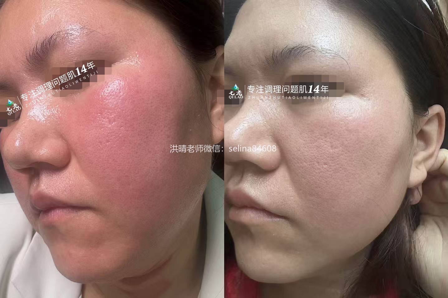 七老发红发烫大红脸玫瑰皮修护案例