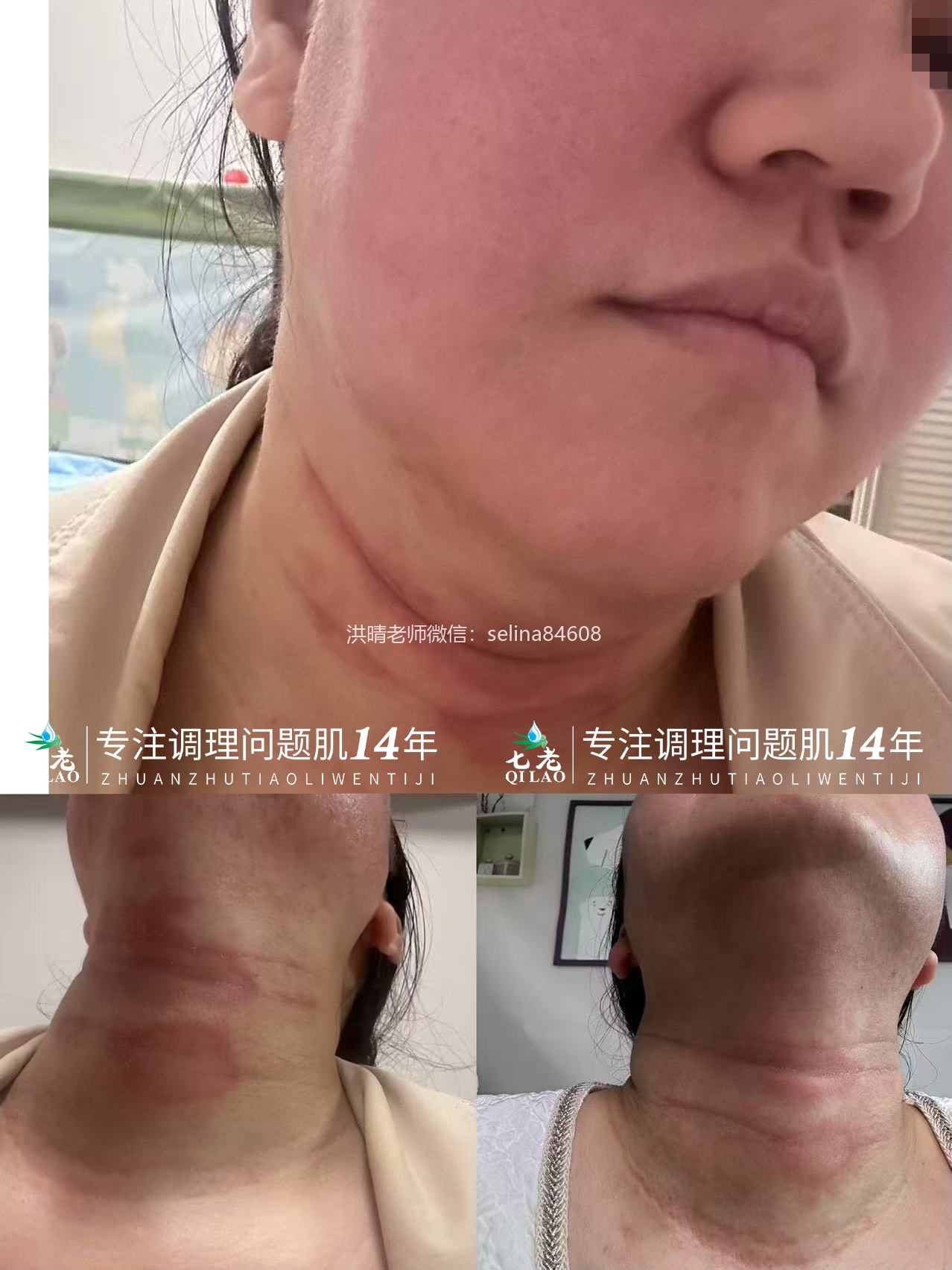 七老发红发烫大红脸玫瑰皮修护案例