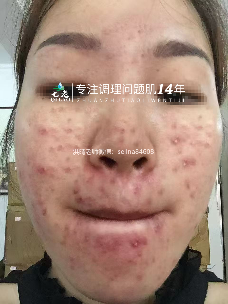 七老激素脸激素痘玫瑰痤疮皮炎修护案例