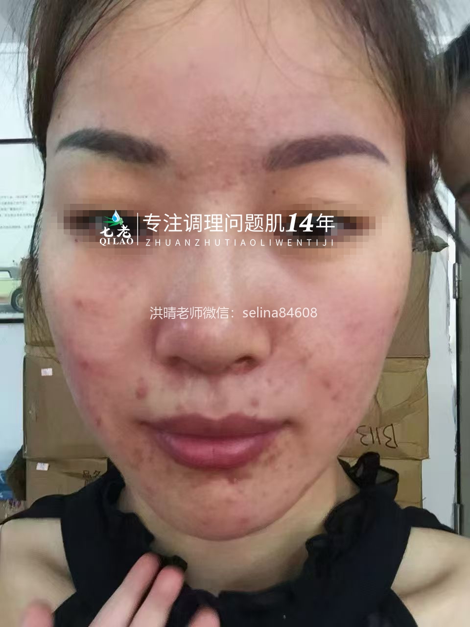 七老激素脸激素痘玫瑰痤疮皮炎修护案例