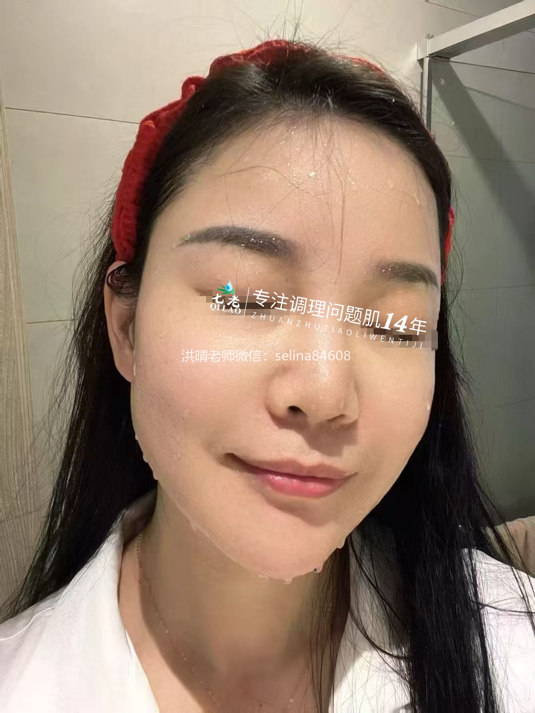 七老激素脸激素痘玫瑰痤疮皮炎修护案例