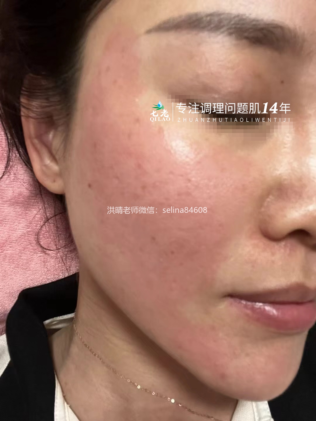 七老激素脸激素痘玫瑰痤疮皮炎修护案例