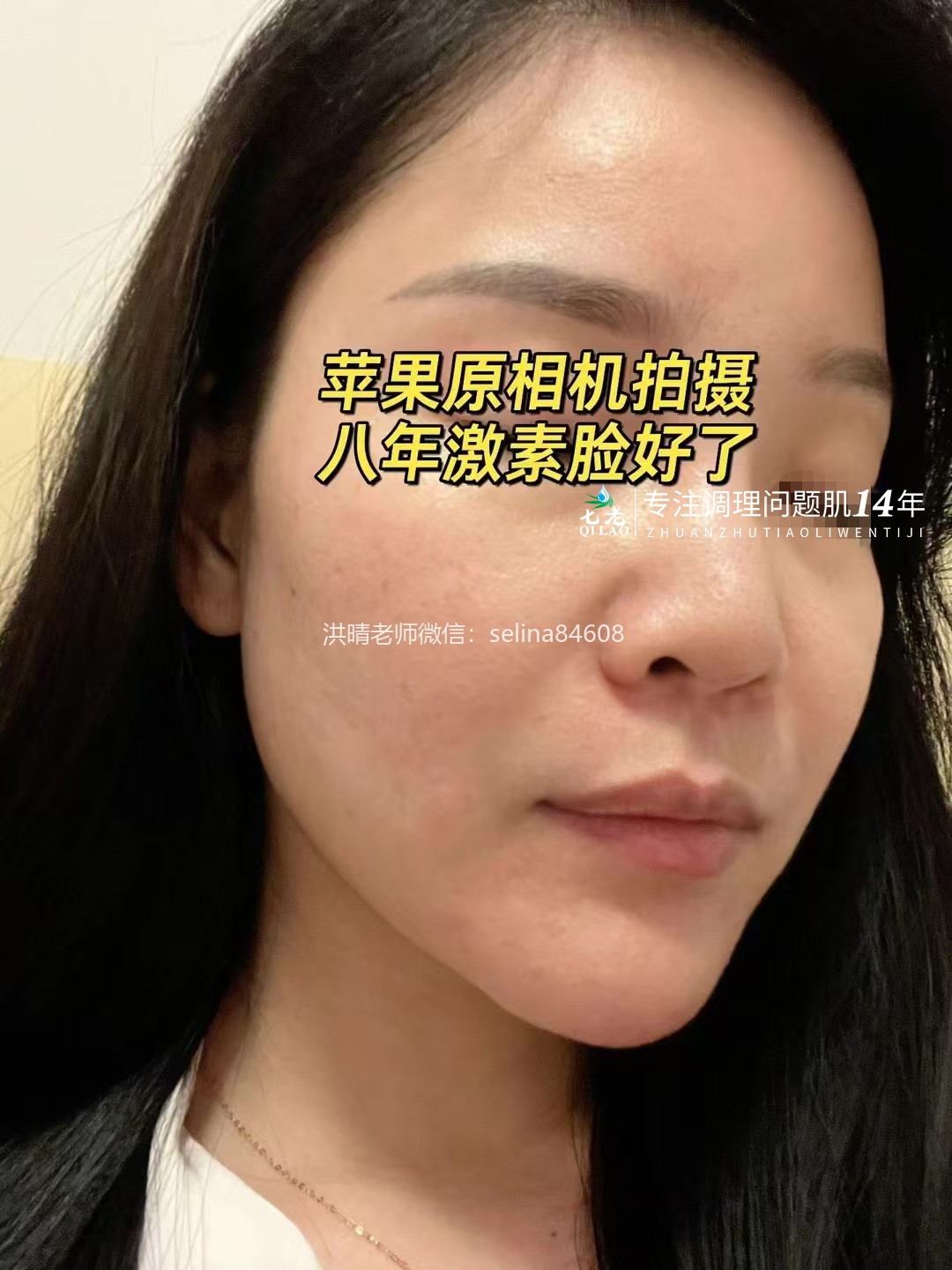 七老激素脸激素痘玫瑰痤疮皮炎修护案例