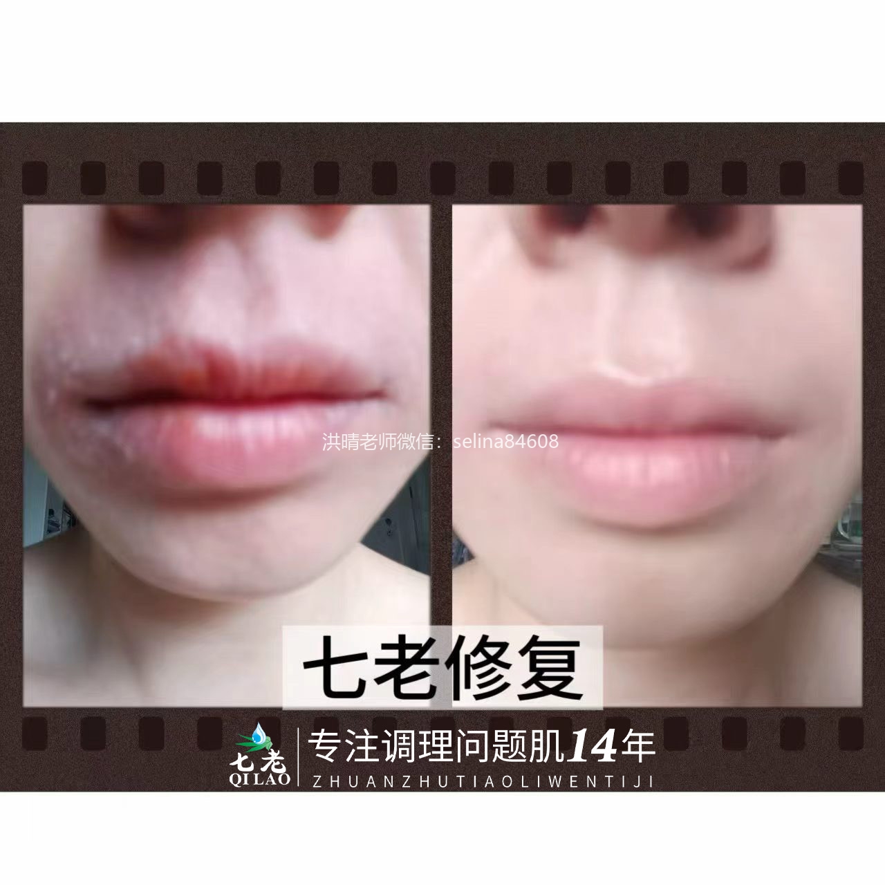 七老胶原水光修护口周皮炎反馈对比