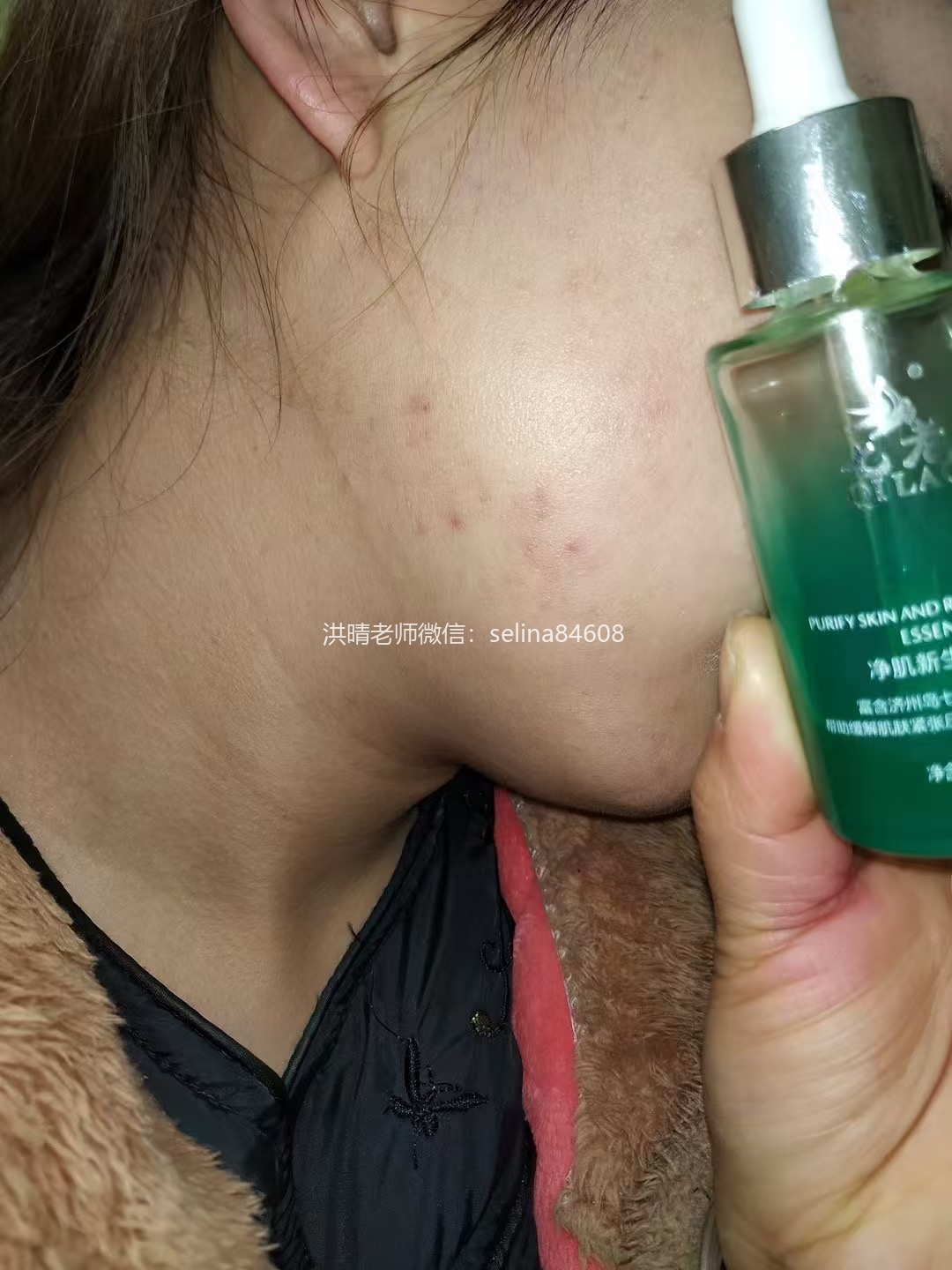 七老顽固粉刺痘痘修护案例