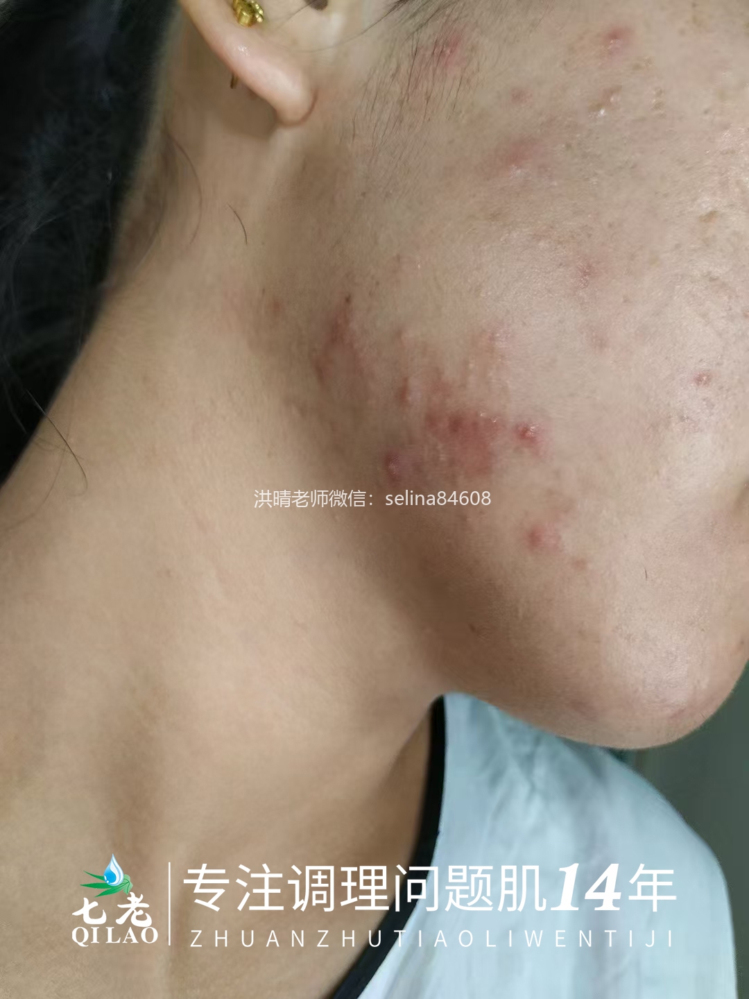 七老顽固粉刺痘痘修护案例