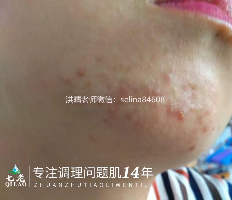 七老顽固粉刺痘痘修护案例