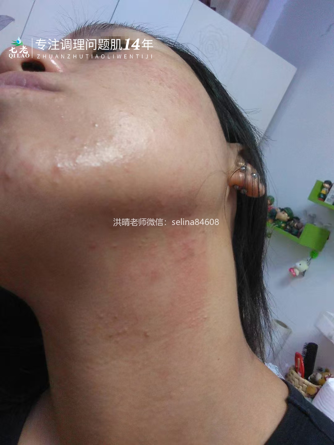 七老顽固粉刺痘痘修护案例