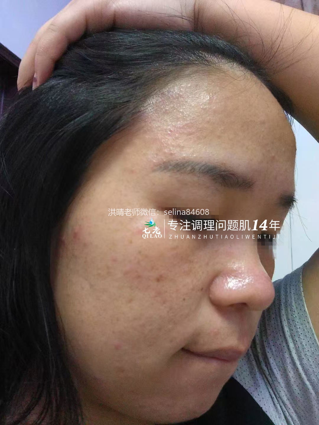 七老顽固粉刺痘痘修护案例