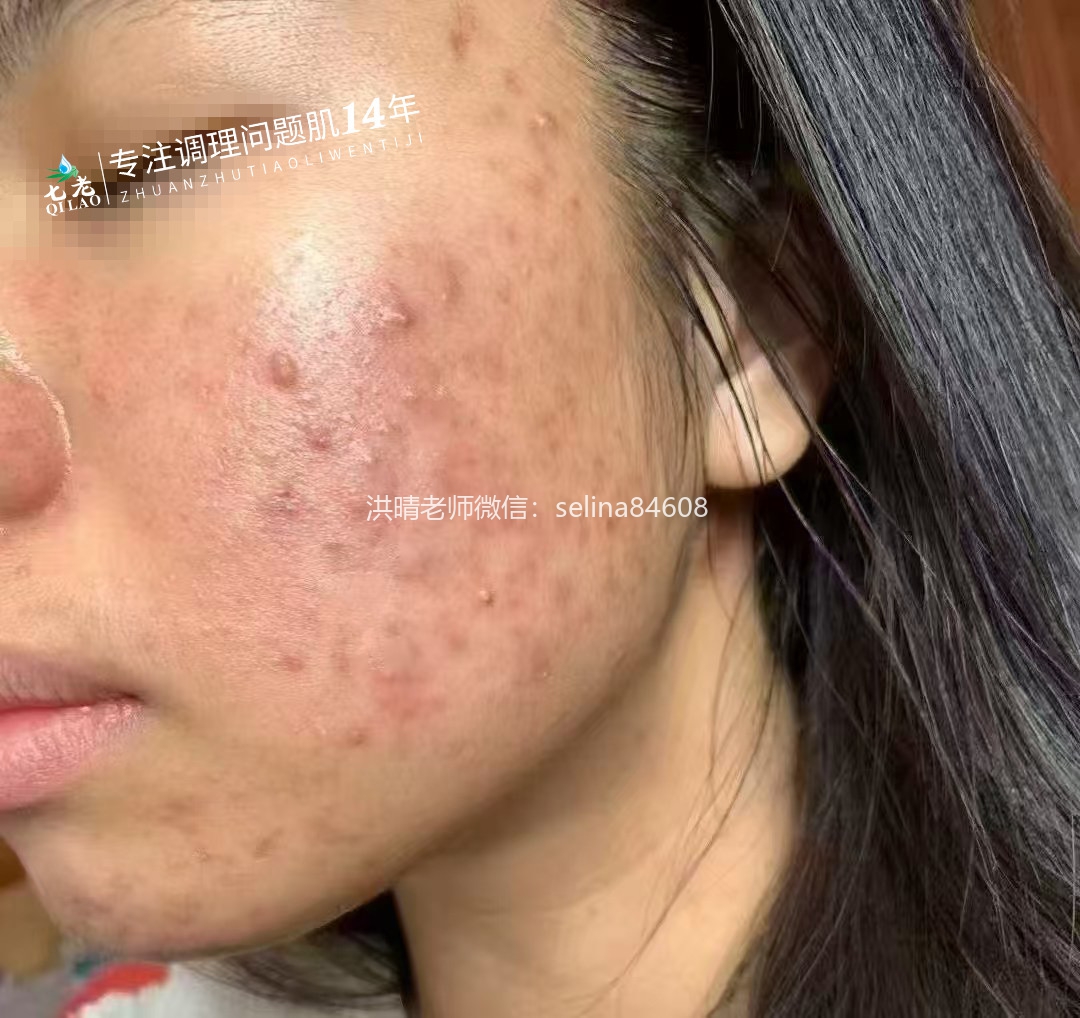 七老激素脸激素痘痘玫瑰皮修护案例