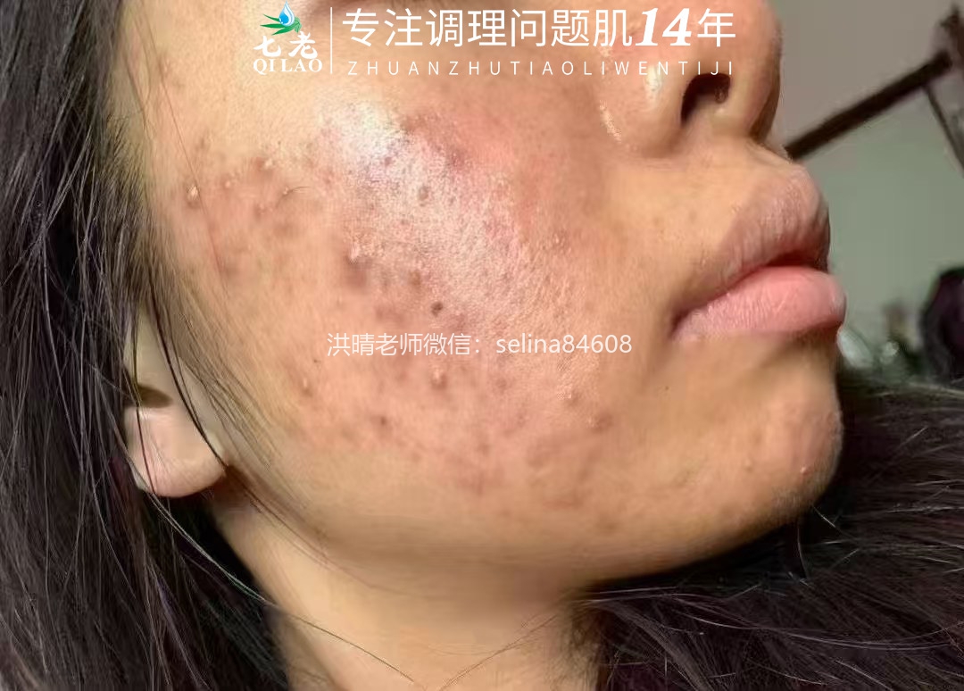 七老激素脸激素痘痘玫瑰皮修护案例